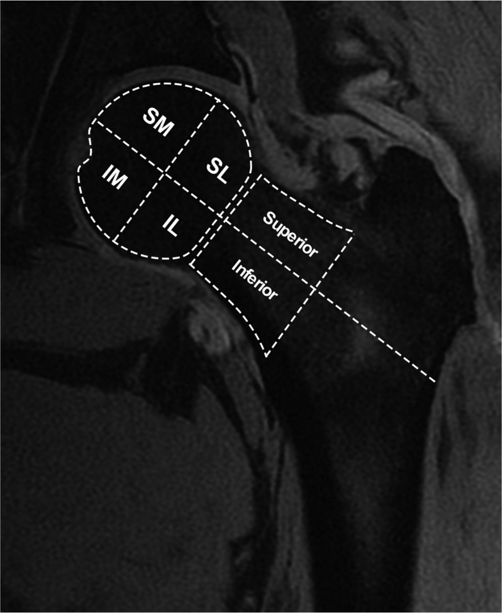 Fig. 2 
            Representative coronal MRI image of left hip demonstrating regions of interest for quantitative MRI analysis. Four regions in the femoral head (superomedial (SM), superolateral (SL), inferomedial (IM), and inferolateral (IL) quadrants) and two regions in the femoral neck (superior and inferior) were evaluated.
          