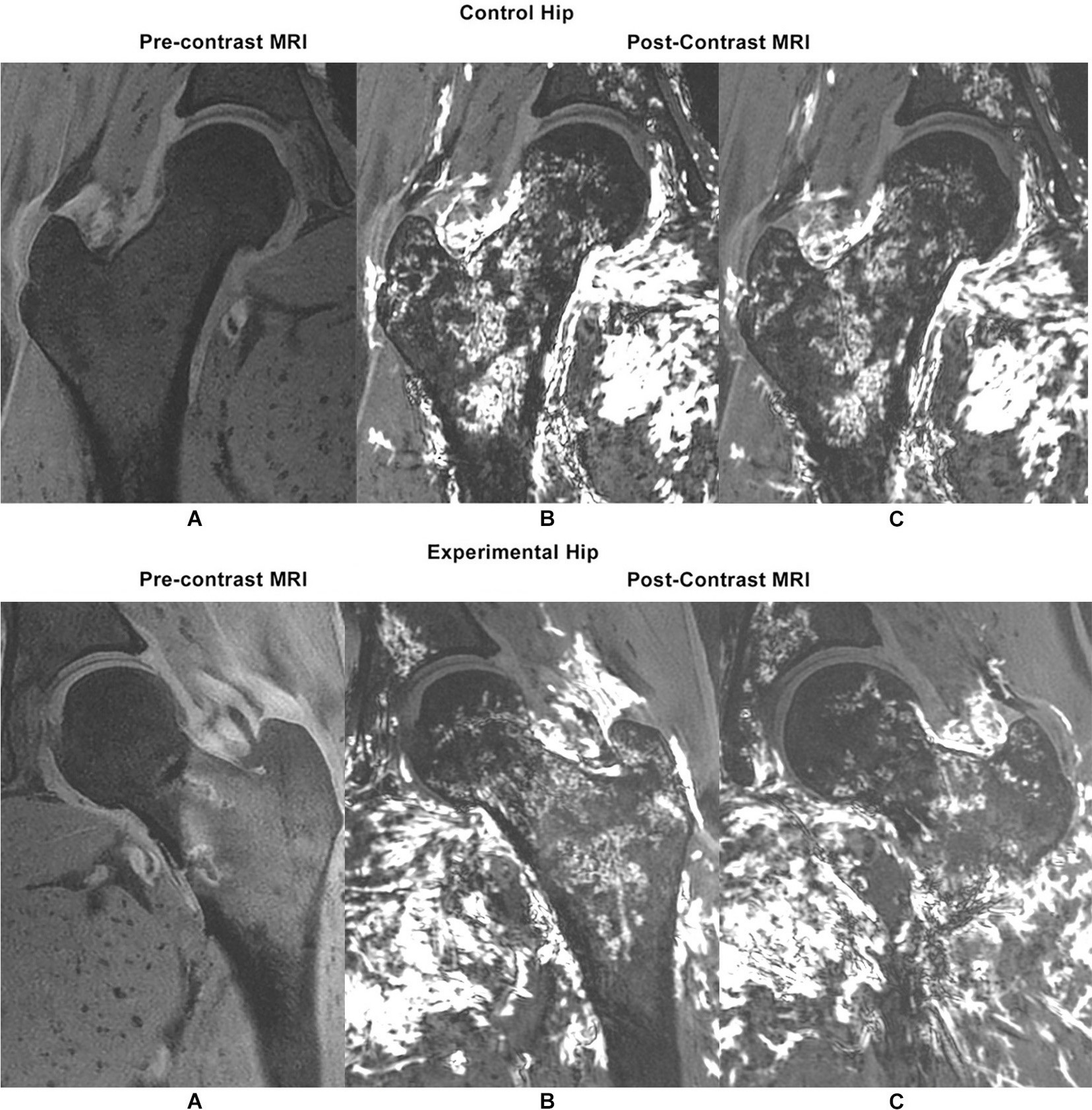 Fig. 3 
          Representative pre- and post-contrast coronal MRI images of a) control hip, and b) contralateral experimental hip following application of a five-hole one-third tubular plate 6:00 position on the clockface. The arterial contributions to the femoral head and neck, including both inferior and superior retinacular arterial systems, are preserved in the experimental hip.
        