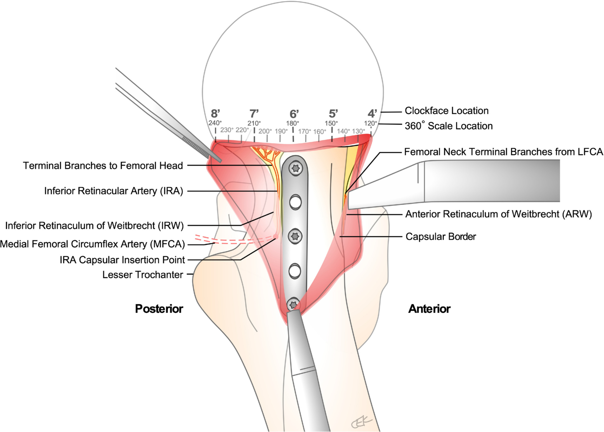 Fig. 4 
          Schematic of left femoral neck calcar following a Hueter approach, capsulotomy, and application of a one-third tubular plate at the 6:00 position on the clockface, where 12:00 is defined as the superior neck and 3:00 is defined as the anterior neck. The inferior retinacular artery (IRA), a terminal branch of the MFCA, courses along the posteroinferior neck within the inferior retinaculum of Weitbrecht (IRW). It is critical to preserve the IRA, and its vascular supply to the femoral head, while securing a buttress plate along the femoral neck calcar at 6:00. This is done through elevation of the inferior capsule and IRW off bone, placement of a Hohmann retractor along the inferior femoral neck, and hip external rotation with slight flexion.
        