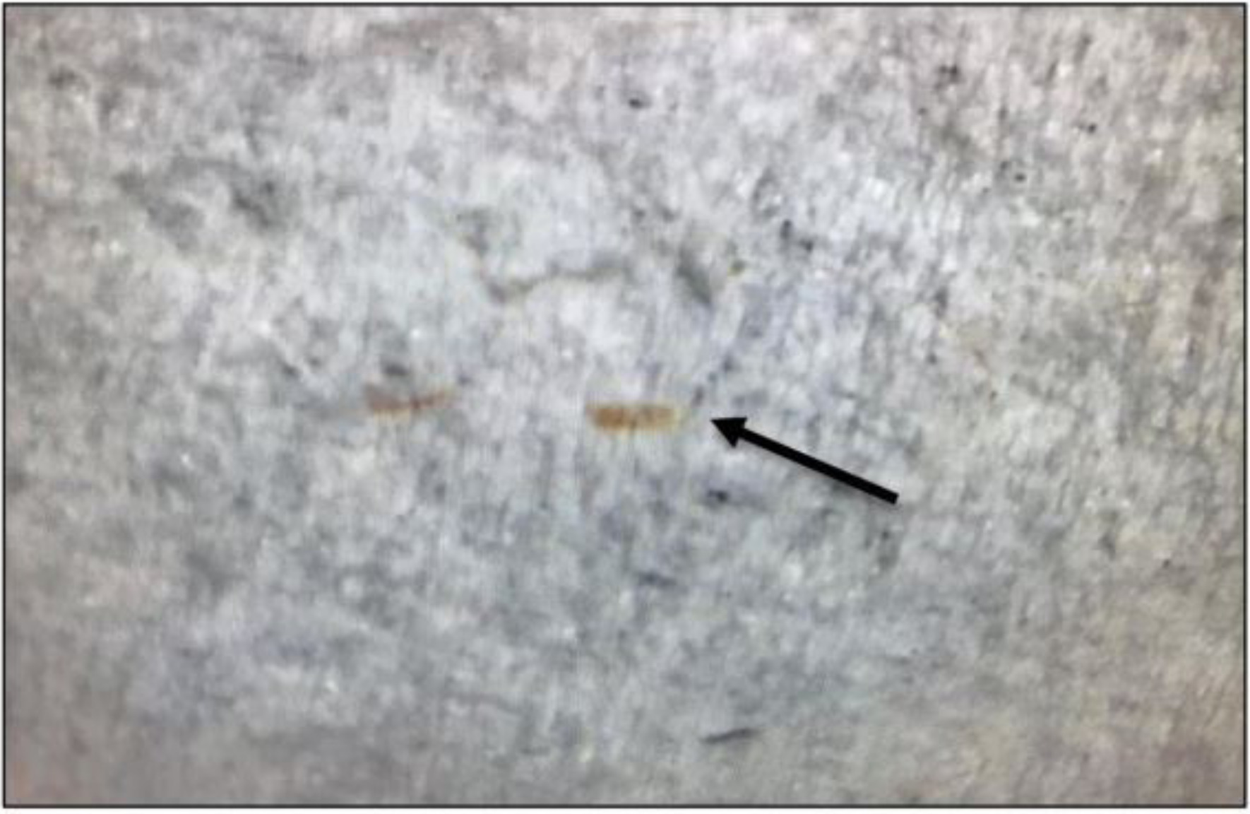 Fig. 2 
            Microscopic drill splatter using Solution 1 at 20 cm height, with more than 98 cm microscopic droplet displacement on the floor sheet using the Carl Zeiss surgical microscope at × 10 magnification.
          