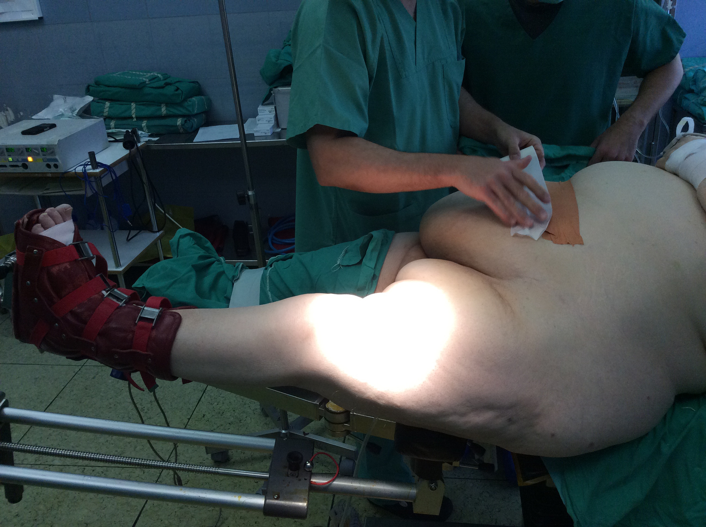 Fig. 1 
            A morbidly obese patient is positioned on the traction table. Abdominal pannus was retracted out of surgical field with taping.
          