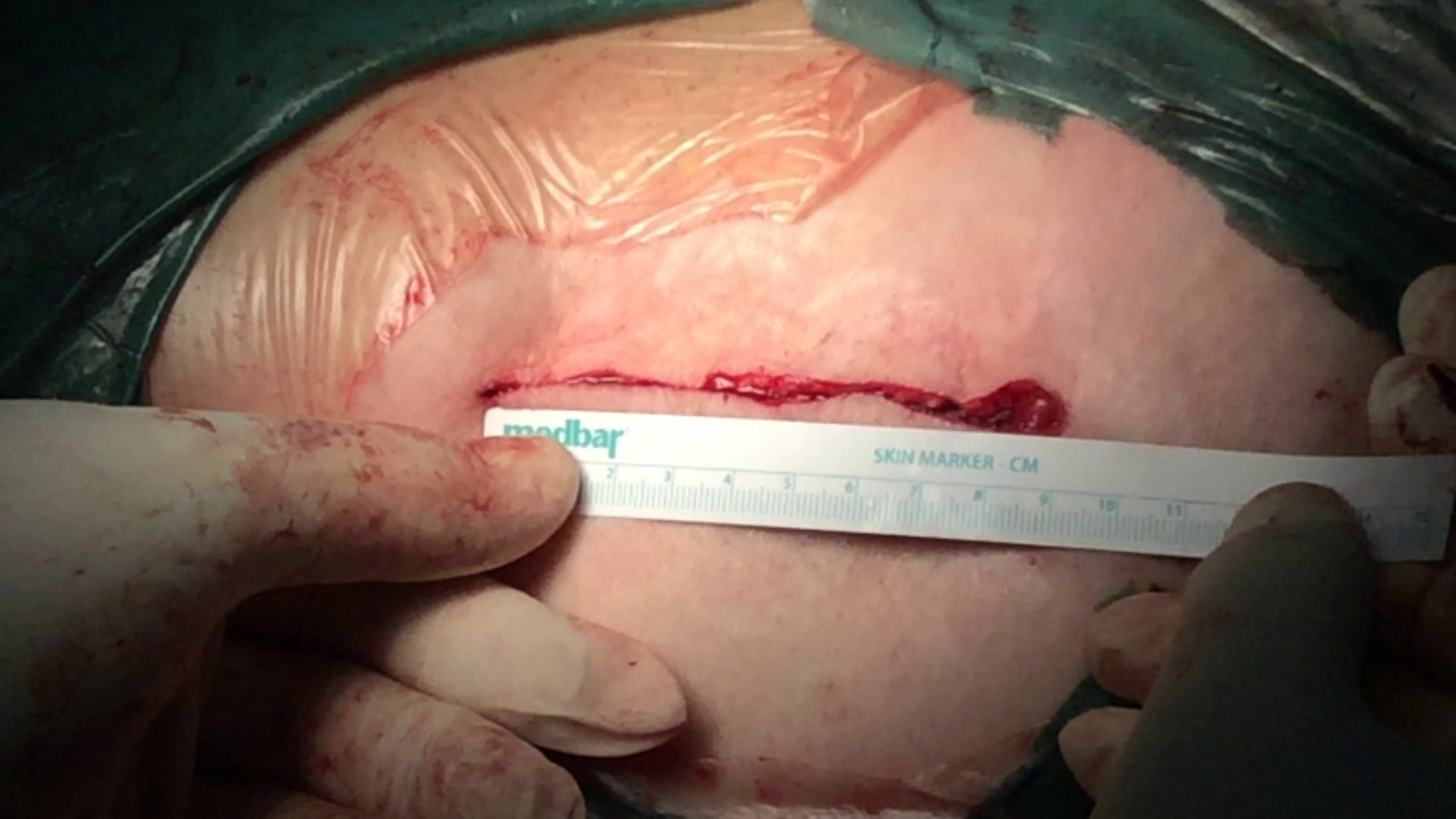 Fig. 2 
            Skin incision. Length of skin incision during wound closure.
          