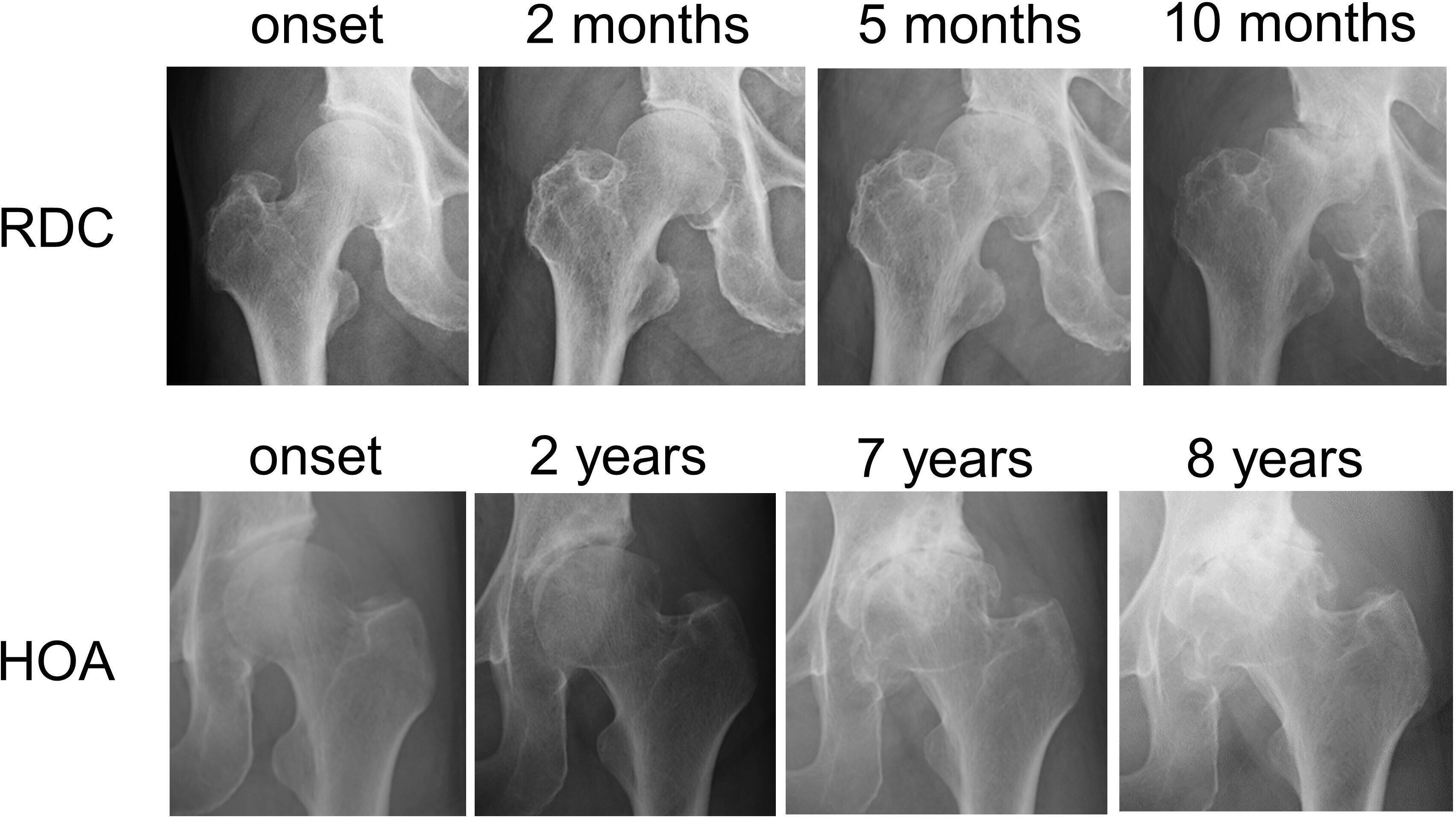 Fig. 1 
            Disease progression of rapidly destructive coxopathy (RDC) and hip osteoarthritis (HOA). Right hip joint with RDC demonstrating chondrolysis at two months, partial destruction of the femoral head at 5 months, and its massive destruction at ten months after the onset of hip pain. Sharp angle of the right hip was 42° at the onset of hip pain. Left hip joint with HOA showing slight joint space narrowing at two years, partial destruction of the femoral head with osteophyte formation in the acetabulum and femoral head at seven years, and exacerbating femoral head destruction at eight years after the onset of hip pain. Sharp angle of the left hip was 50° at the onset of hip pain.
          