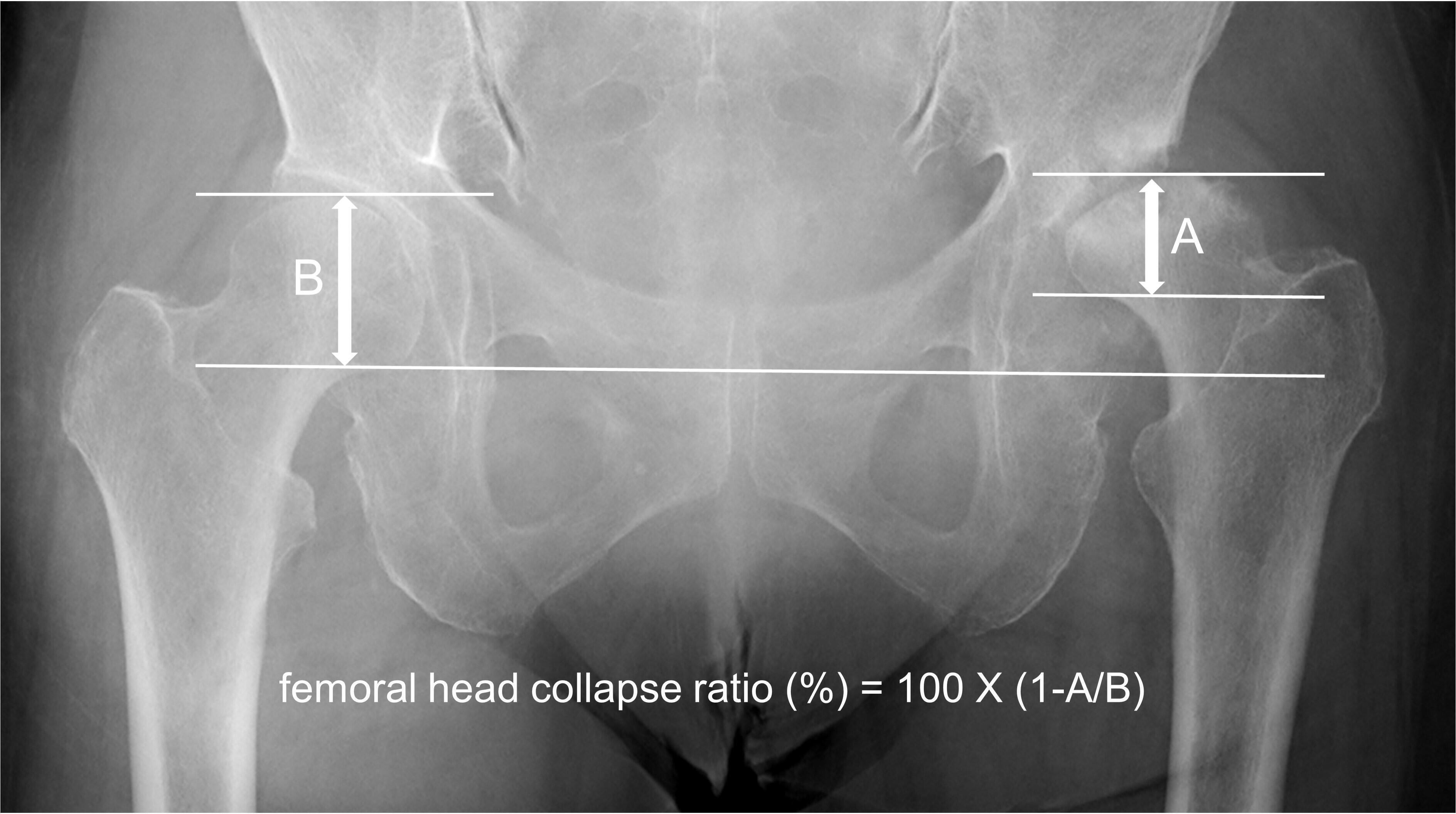 Fig. 2 
            Measurement of the femoral head collapse ratio. On the last anteroposterior radiograph taken within 12months after the onset of hip pain, the vertical distance is measured between the two separate lines parallel to the radiological teardrop line drown through the most proximal and distal portions of the affected (A) and non-affected (B) femoral heads. The femoral head collapse ratio (%) is calculated with the equation as femoral head collapse ratio (%) = 100×(1 A/B).
          