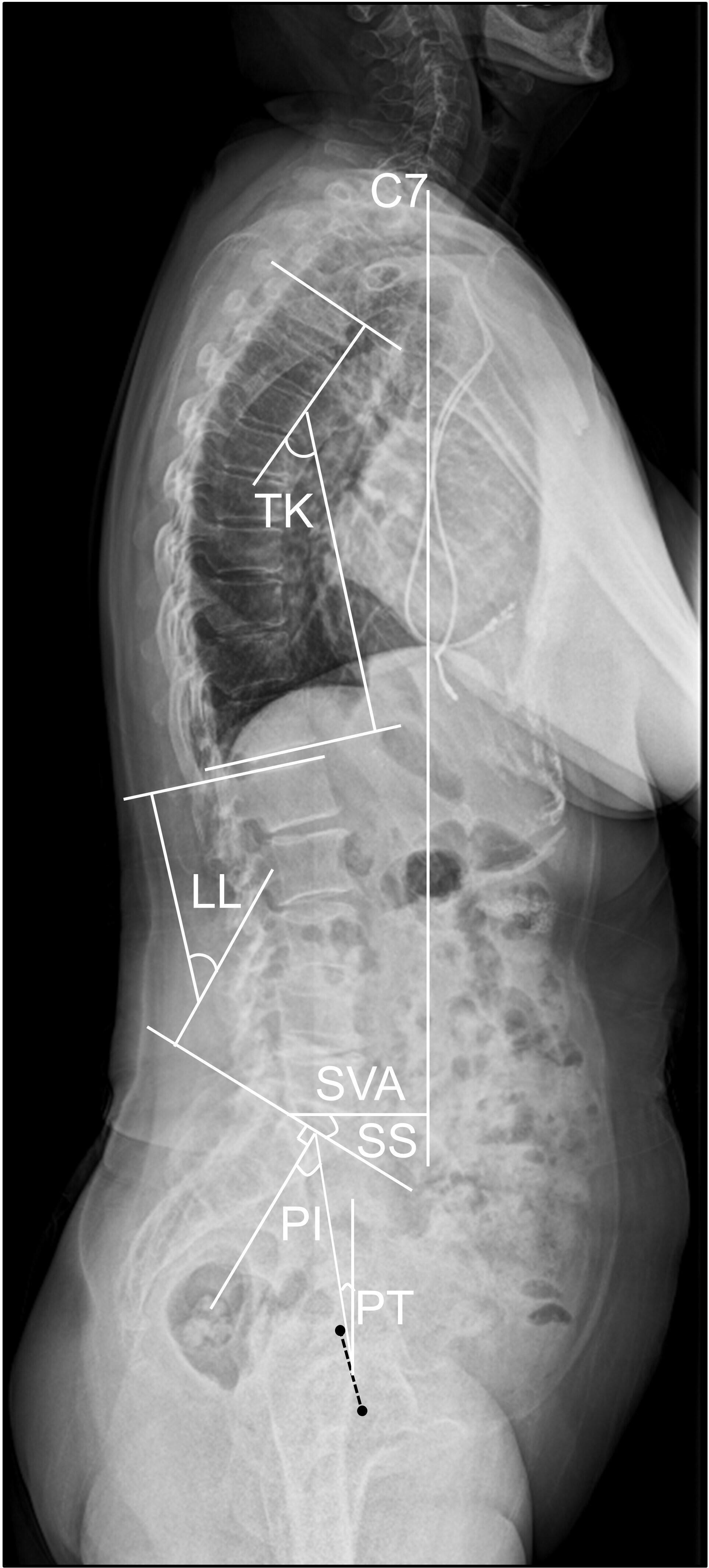 Fig. 3 
            Illustration of the radiological parameters of the sagittal alignment of the spine and pelvis. PI, pelvic incidence; PT, pelvic tilt; SS, sacral slope; LL, lumbar lordosis angle; TK, thoracic kyphosis angle; SVA, sagittal vertical axis.
          