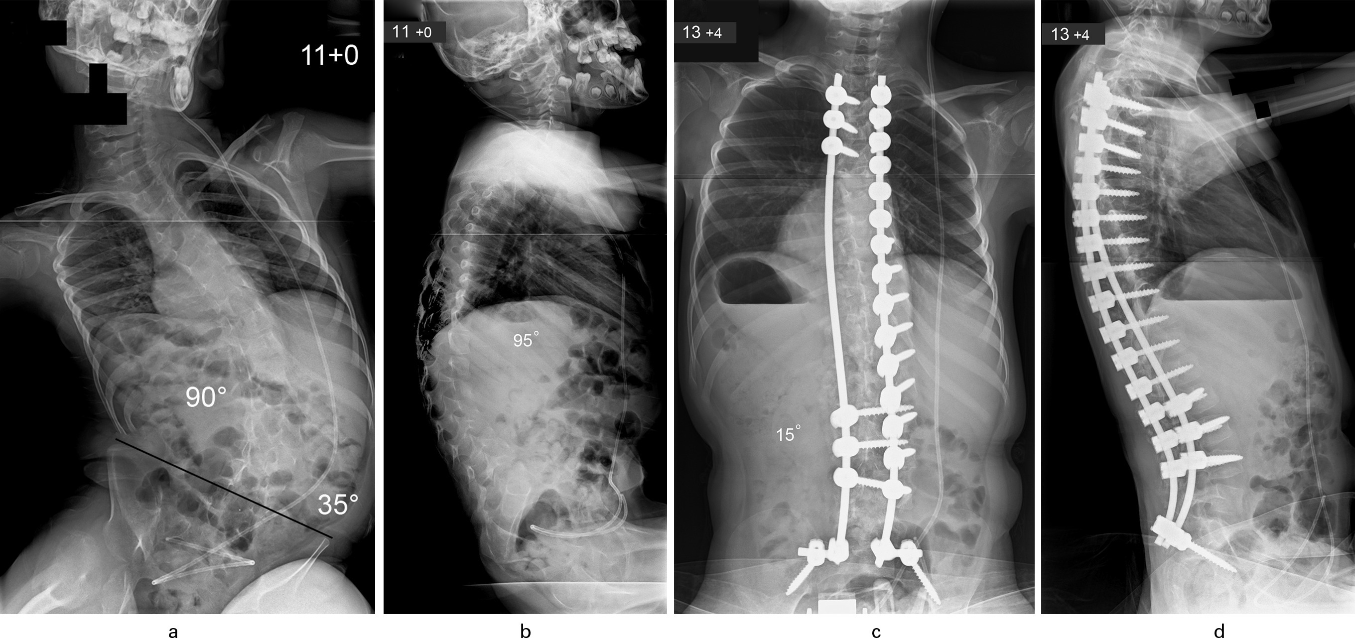 Fig. 1 
            Patient aged 11 years with congenital encephalopathy, hydrocephalus, and total body cerebral palsy. a) Typical long C-shaped collapsing thoracolumbar scoliosis (90o) with associated severe pelvic obliquity (35o); b) Thoracolumbar kyphosis producing positive global sagittal balance of the spine. c) Excellent correction of scoliosis to 15o and levelling of the pelvis was achieved through a posterior spinal fusion using segmental pedicle screw/rod instrumentation (aged 13 years and four months). d) Restoration of normal thoracic kyphosis and lumbar lordosis with adequate global sagittal balance noted after spinal surgery.
          