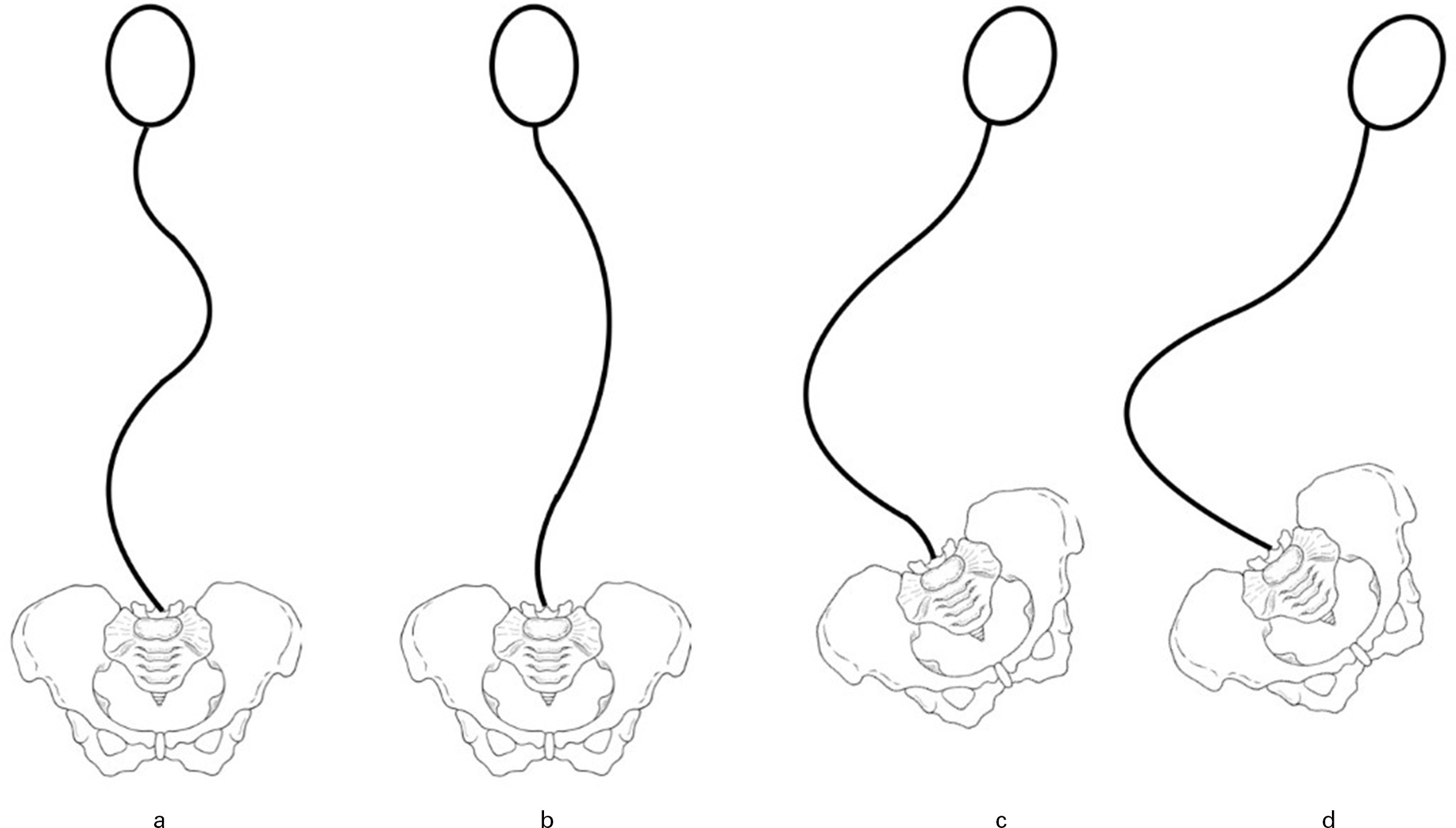 Fig. 2 
            Classification of scoliosis in patients with cerebral palsy. a) Group 1 curves: trunk compensated and presenting as well-balanced double curve. b) Group 1 curves: trunk compensated and presenting as major thoracic curve with small fractional lumbar curve. c) Group 2 curves: decompensated trunk with pelvic obliquity and a small fractional curve between the caudal end of the main curve and the sacrum. d) Group 2 curves: decompensated trunk with pelvic obliquity and the main curve extending distally to include the sacrum.
          