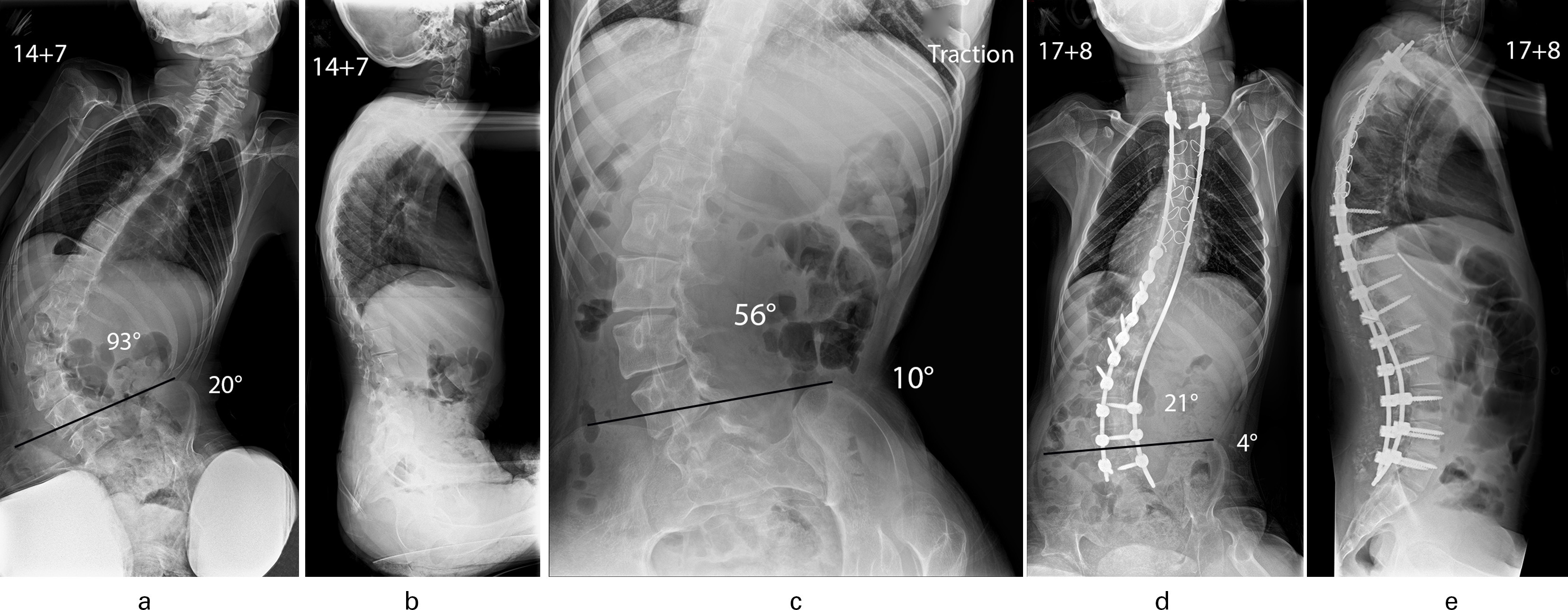Fig. 3 
            Patient aged 14 years and seven months with quadriplegic cerebral palsy. a) Collapsing lumbar scoliosis (93o) with associated pelvic obliquity (20o). b) Increased thoracic kyphosis with elimination of normal lumbar lordosis and positive global sagittal balance of the spine. c) Supine traction radiograph shows the scoliosis to improve to 56o and the pelvic obliquity to retain flexibility and correct to 10o. d) Excellent correction of scoliosis to 21o and marked improvement of pelvic obliquity to 4o was maintained at follow-up (aged 17 years and eight months) after a posterior spinal fusion using a hybrid segmental pedicle screw/sublaminar wire/rod construct extending distally to L5; E: Spinal surgery restored thoracic kyphosis/lumbar lordosis and balanced the spine.
          