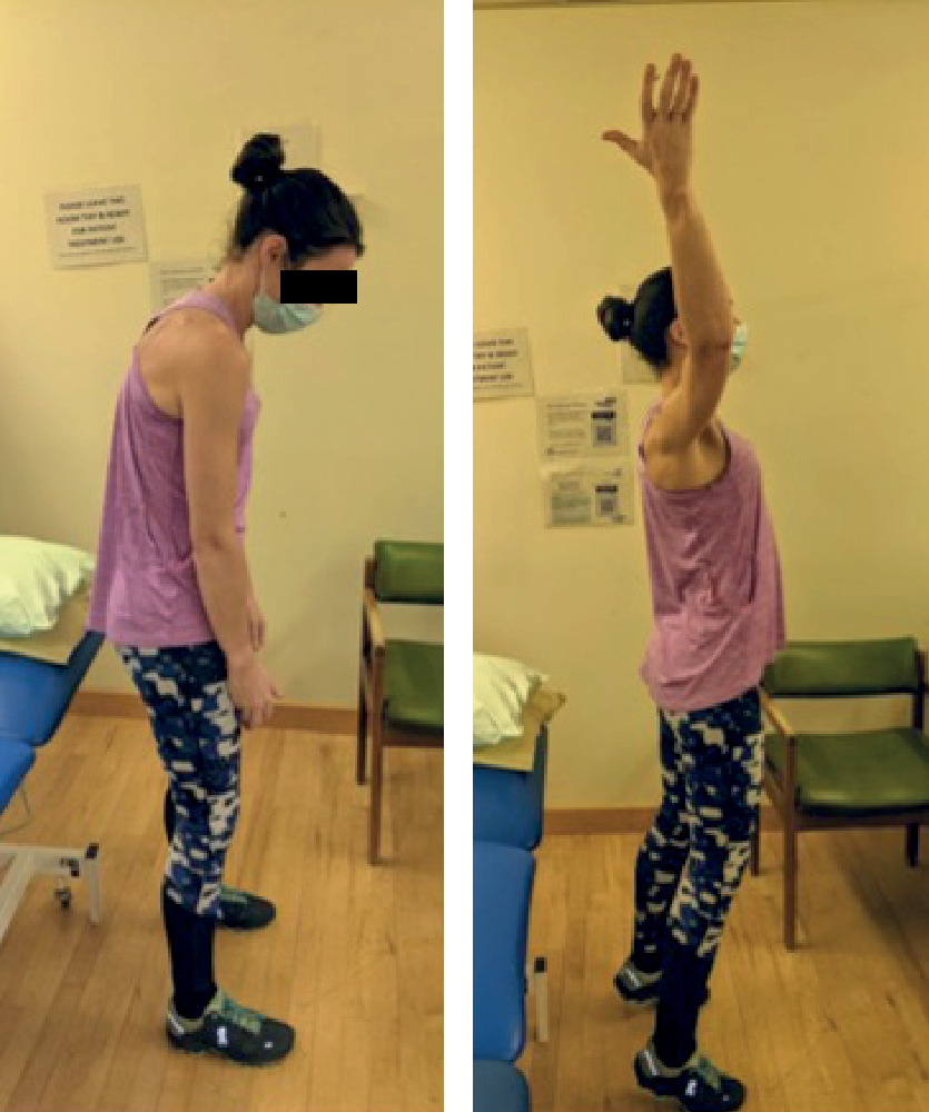 Fig. 4 
            Scapular setting. The physiotherapist facilitates correction of the patient's chin poke posture and protracted shoulder girdle posture by encouraging scapular/cervical retraction, and abdominal pull-in while elevating the arm.
          