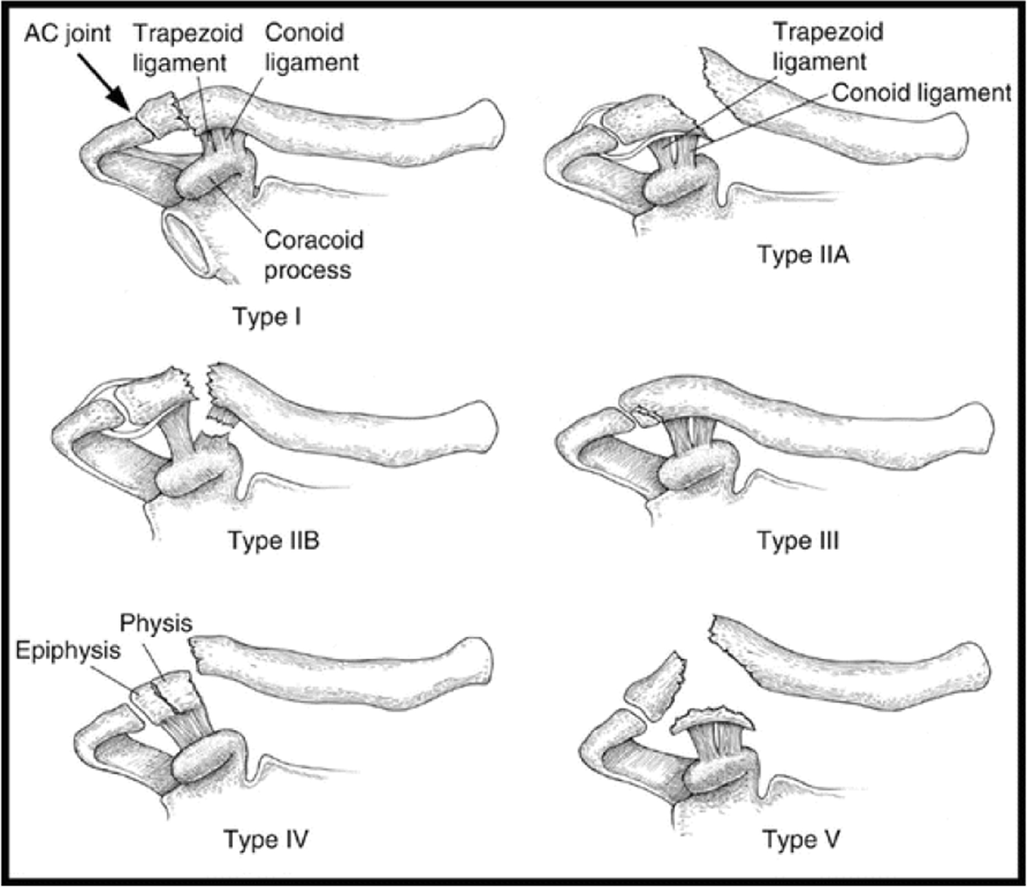 Fig. 1 
          Diagrammatic representation of the modified Neer classification for distal third clavicle fractures. AC, acromioclavicular.
        