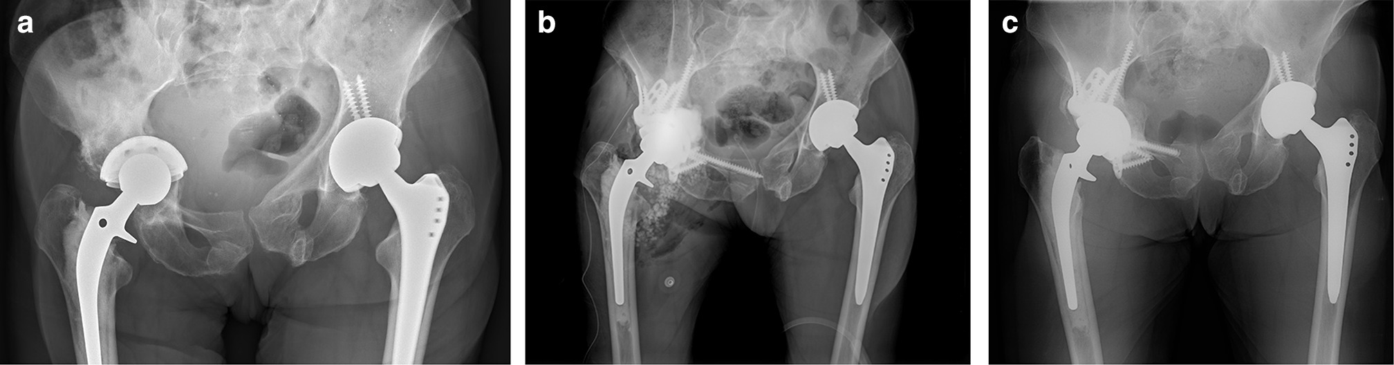 Fig. 1 
          a) Anteroposterior (AP) pelvic radiograph of a 75-year-old female with a painful, aseptically loose right revision acetabular component showing protrusion of right cementless porous cup (prior cemented cup). CT scan showed segmental bone loss of anterior column and medial quadrilateral plate. b) Postoperative AP pelvic radiograph showing pelvic reconstruction with MaxTi triflange cage. 18 ml of Cerament was injected behind the cage into all defects before cementing the acetabular component into the cage. c) AP pelvic radiograph 16 months postoperatively. Pelvic reconstruction remains stable. Note the area of Cerament where remodelling has occurred. Remodelling has progressed to an appearance that suggests transformation into bone. Also note the removal of 15 mm of superior ramus screw tip which exited the anterior cortex and was a focal area of discomfort when wearing pants. The exposed screw was removed at 14 months postoperatively with a limited incision.
        