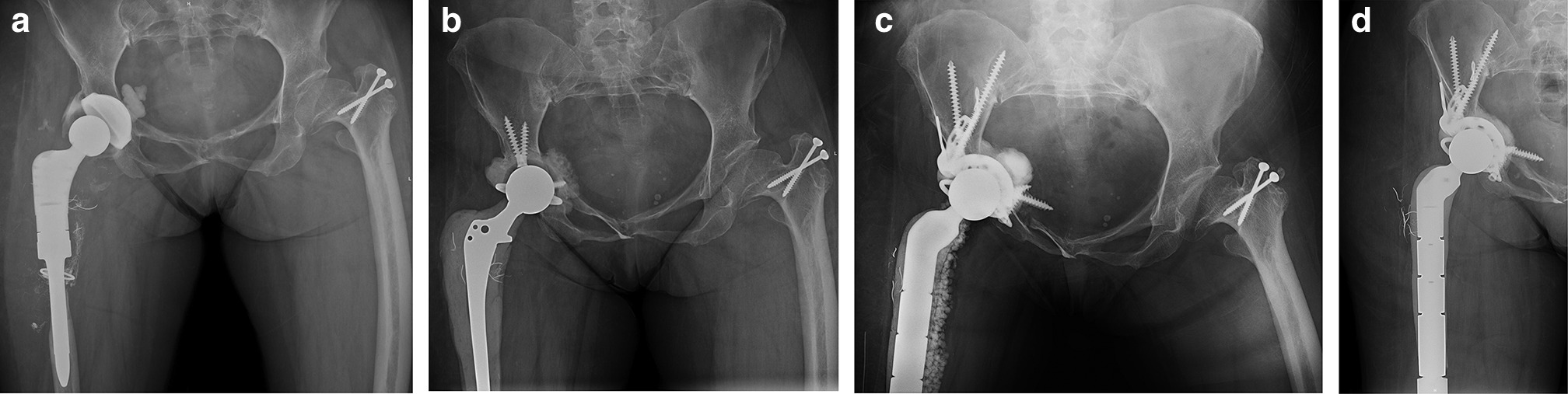 Fig. 2 
          a) Anteroposterior (AP) radiograph of pelvis and upper femur region showing infected endoprosthetic total hip arthroplasty (THA) of a 53-year-old female with a chronic periprosthetic joint infection of her fourth revision right THA. The patient has epiphyseal dysplasia. A draining sinus was present over the lateral mid-thigh. A polyethylene bearing is cemented into the cementless cup. There is cement behind the metal cup. The infecting organism was Cutibacterium. b) AP radiograph of endoprosthetic PROSTALAC (PROSThesis Antibiotic Loaded Acrylic Cement) construct at six months. The patient is ambulatory with partial weight with a walker. Three preoperative aspirations are negative. c) Postoperative AP radiograph showing pelvic reconstruction with MaxTi triflange cage; 10 ml of Cerament was injected behind the cage into all defects before cementing the acetabular component into the cage. A constrained bearing was cemented into the cage construct. d) AP pelvic radiograph 12 months postoperatively. The pelvic reconstruction remains stable. Note the area of Cerament where remodelling has occurred. Remodelling is rated radiologically as moderate.
        