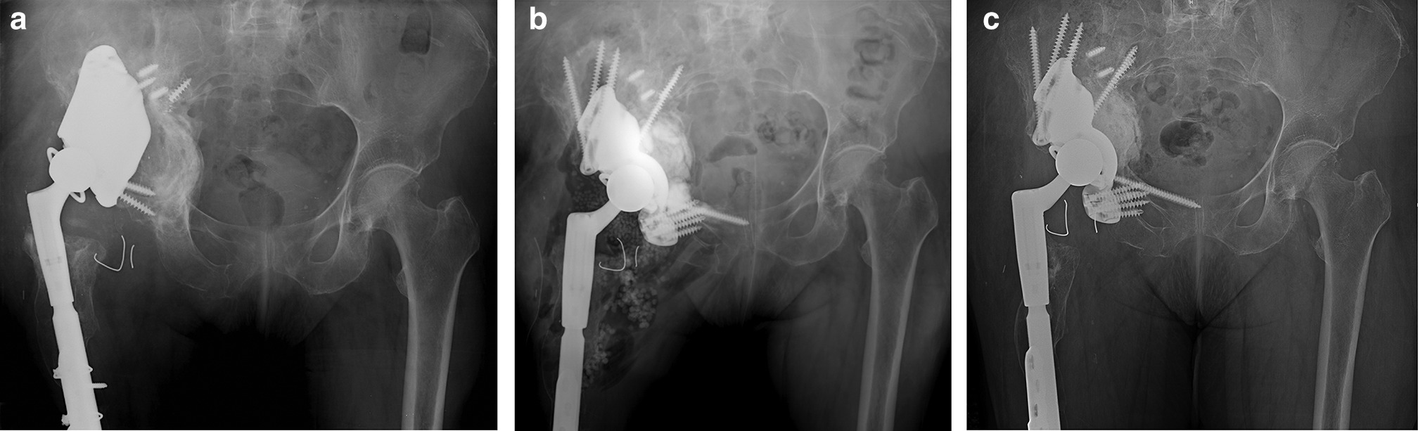 Fig. 3 
          a) Anteroposterior (AP) radiograph of pelvis and upper femur region showing loose spanning porous cage of a 65-year-old female who had undergone five prior revision total hip arthroplasty procedures resulting from prior trauma. The cage has failed via an abduction pullout mechanism from the inferior pelvis. An extended polyethylene (+ 5 mm) constrained bearing is locked into the cage. CT scan showed segmental bone loss of posterior column, medial quadrilateral plate, and anterior rim. b) Postoperative AP radiograph showing pelvic reconstruction with a custom triflange porous cage; 28 ml of Cerament was injected behind the cage into all defects before inserting a Freedom constrained bearing into the ring-loc mechanism. A long medullary screw was inserted into the superior ramus to counteract abduction pullout stresses. c) AP pelvic radiograph 66 months postoperatively. Pelvic reconstruction remains stable. The bone graft substitute site shows retroacetabular remodelling, but no trabecular bone patterns are observed.
        
