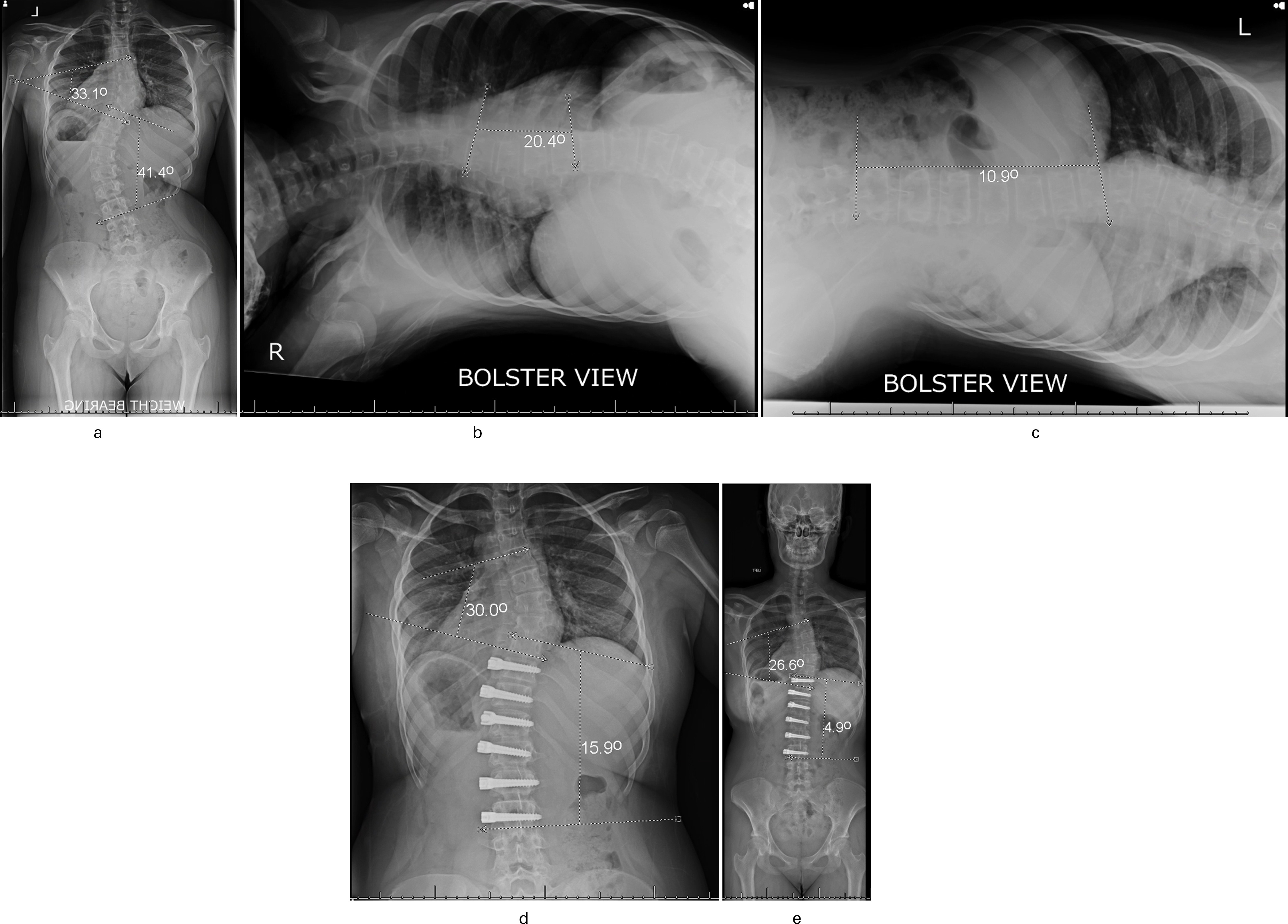 Fig. 3 
          Group Risser grade 0 to 2 (vertebral body tethering growth modulation) 14-year-old female on an anteroposterior whole-spine radiograph. She is Risser 0 and her tri-radiate cartilages are closed. a) There is a main thoracic (MT) Cobb angle of 33.1° and thoracolumbar Cobb angle of 41.4°. b) The Fulcrum Bending radiograph MT unbends to 20.4° and c) the Fulcrum Bending radiograph thoracolumbar (TL) unbends to 10.9° six weeks postoperatively. d) There are preoperative Cobb angles of MT = 30° and TL = 15.9°. e) Radiographs taken at five years postoperatively show further improvement with MT = 26.6° TL = 4.9°
        