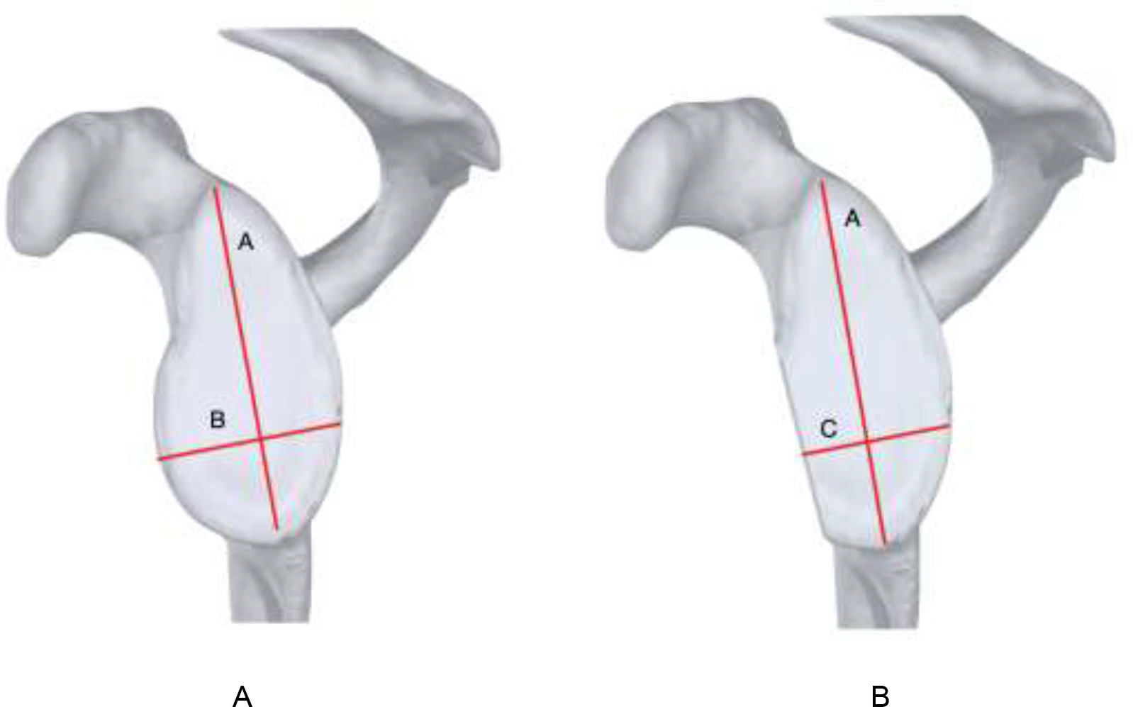 Fig. 1 
            Illustration of landmark linear measurement. The “Griffiths Index”. Anterior shoulder dislocation: Quantification of glenoid bone loss with CT.13 A: Measurements performed on the normal shoulder, B: measurements performed on the injured shoulder.
          