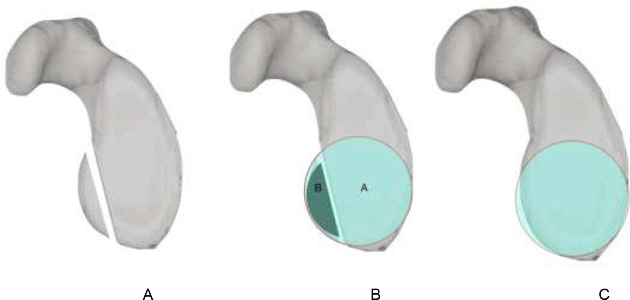 Fig. 8 
            Pico method. From Baudi et al30 A: Illustration of 2D CT with anterior glenoid bone fragment, B: best fit circle incorporating the bone fragment. C: best fit circle on the contralateral glenoid.
          