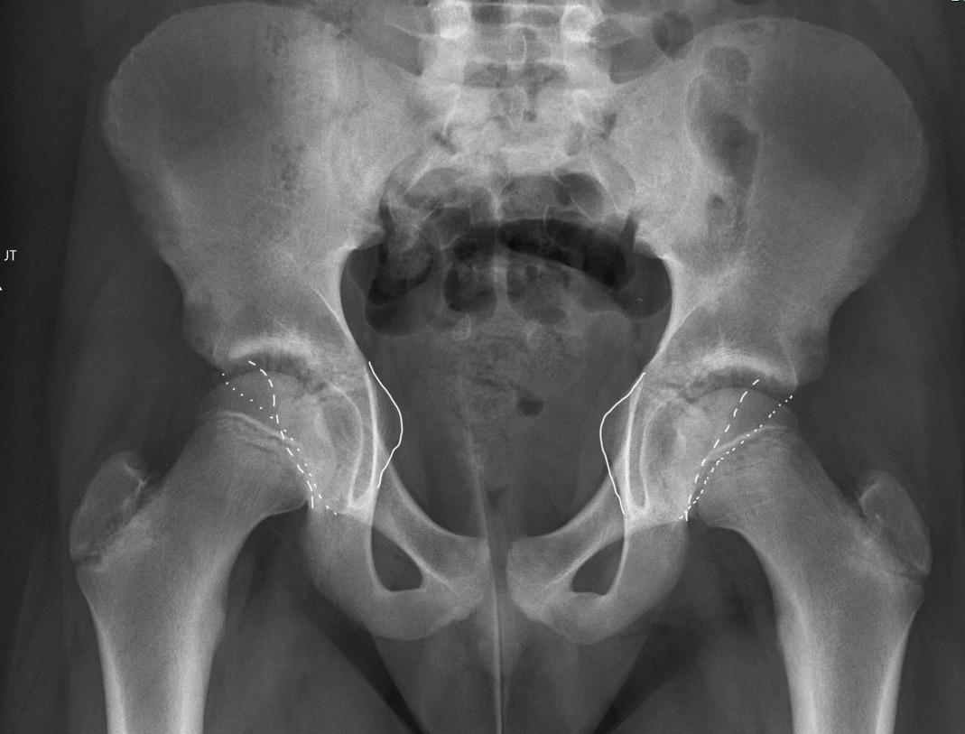 Fig. 2 
          Anteroposterior radiograph of patient with right slipped upper femoral epiphysis, demonstrating ischial spine sign on the solid line, posterior wall sign on the dashed line, and cross over sign on the dotted line.
        