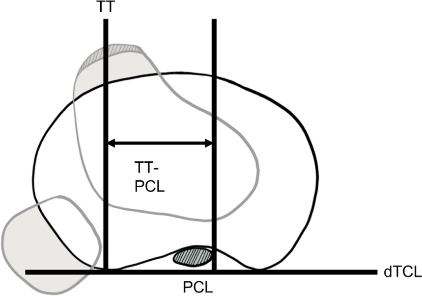 Fig. 3 
            Illustration of tibial tubercle-posterior cruciate ligament measurement.
          