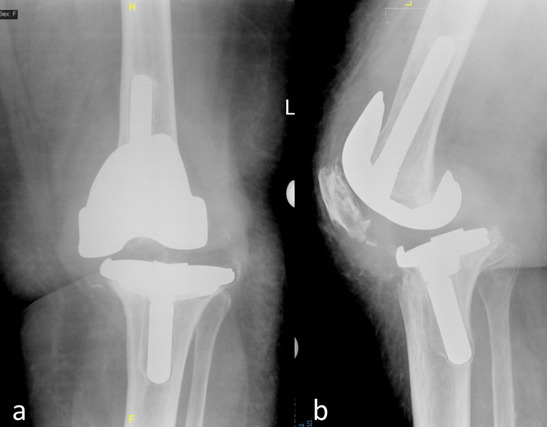 Fig. 2 
            a) Preoperative anteroposterior and b) lateral radiographs of left knee in an 81-year-old female patient with aseptic loosening and instability.
          