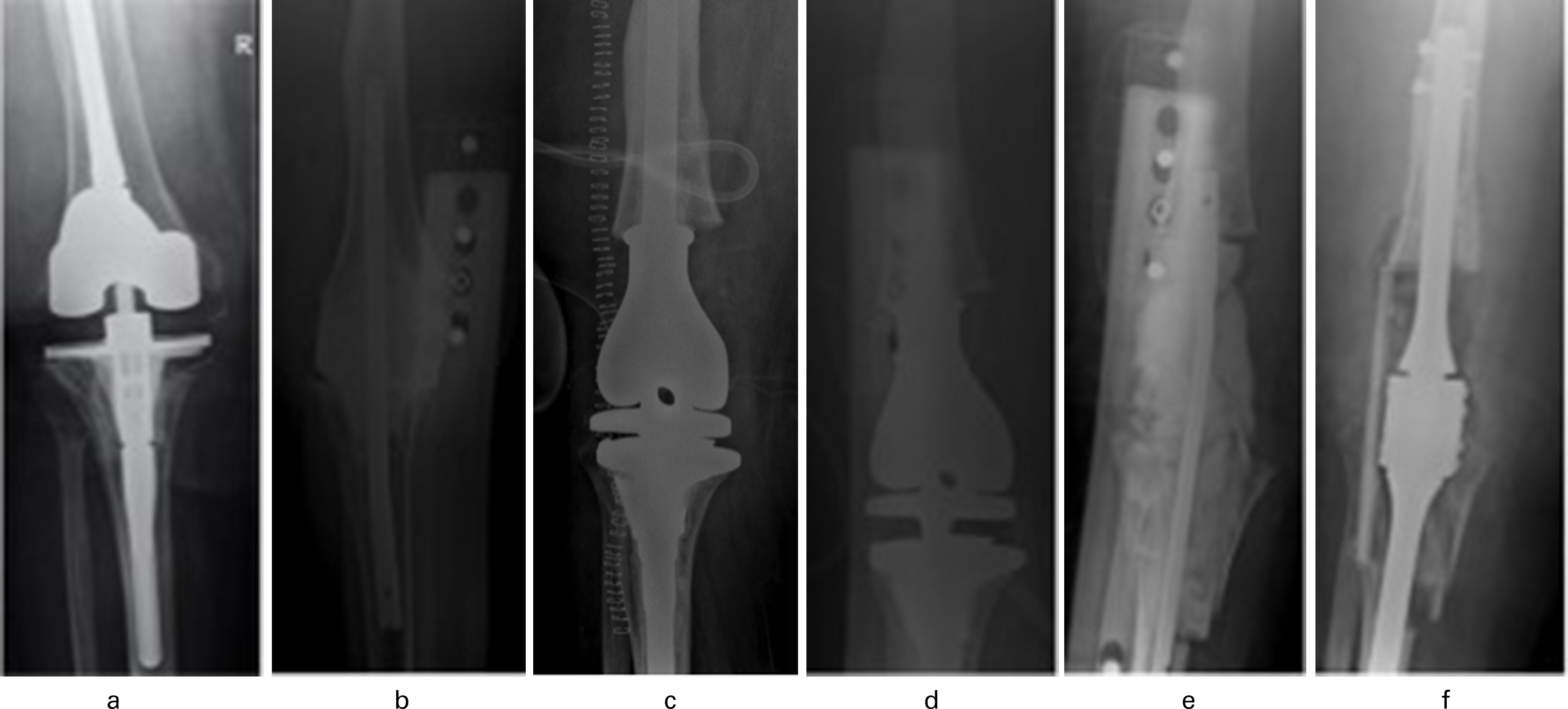 Fig. 5 
          Pre- and postoperative anteroposterior radiographs of a 60-year-old female with prior total knee arthroplasty (2009) and periprosthetic joint infection (PJI) and revision (2010) presenting with a) imaging of her existing total knee arthroplasty. b) Six years after the revision knee arthroplasty and multiple failed antibiotic courses for recurrent methicillin-sensitive Staphylococcus aureus PJI, the implant was explanted and an antibiotic cement spacer was placed. c) Four months later she underwent distal femoral arthroplasty (DFA). d) Due to suspected ongoing PJI she then underwent a polyethylene exchange and irrigation and debridement three weeks later. e) Without resolution of the PJI, she underwent DFA explantation and placement of antibiotic spacer after another two months and, lastly, f) after an additional three months she underwent arthrodesis of the right knee. There have been no signs of PJI since fusion.
        