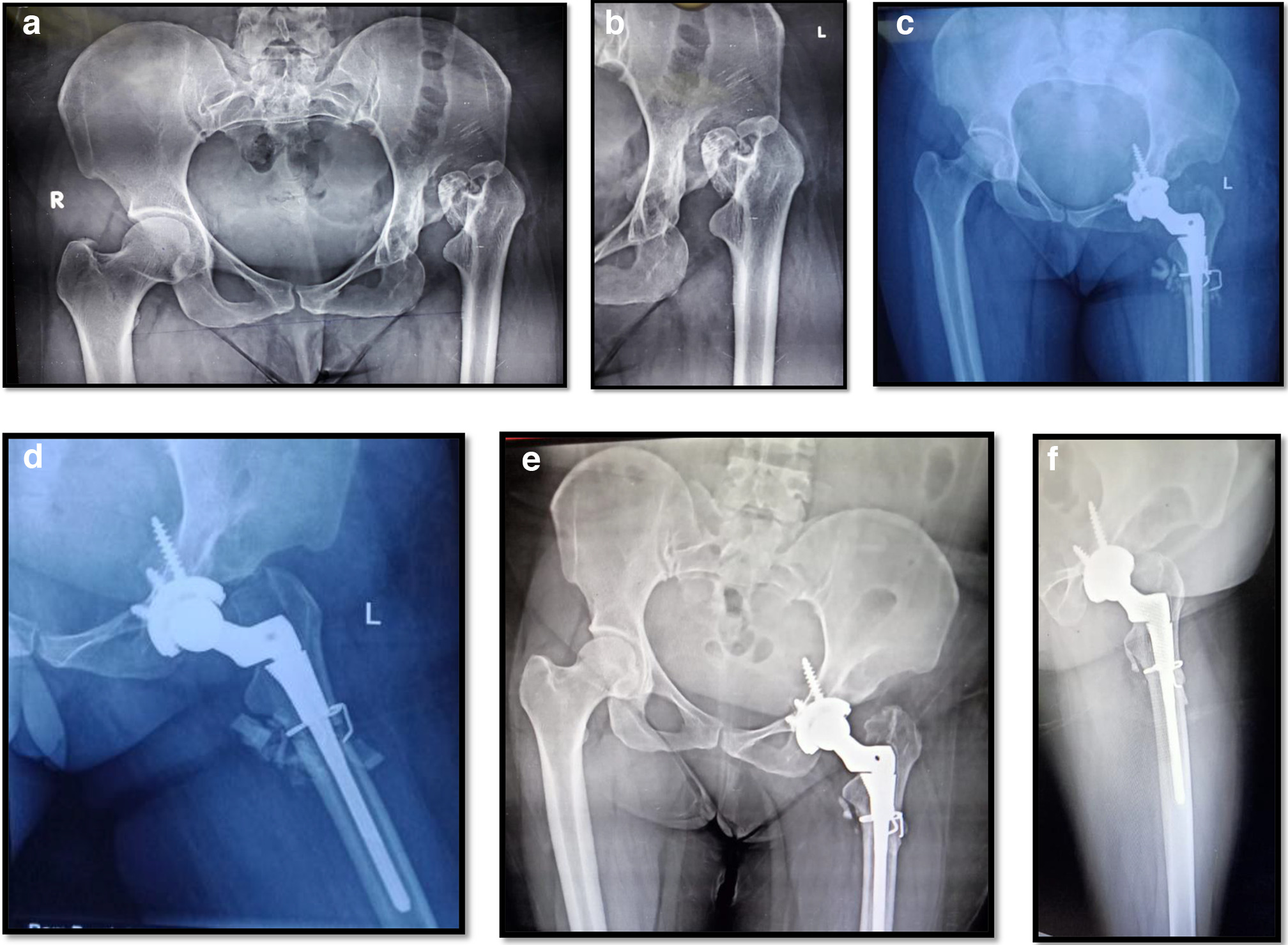 Fig. 1 
          a) Preoperative anterioposterior (AP) radiograph showing the dislocating type of hip following septic arthritis. b) Preoperative lateral radiograph showing the dislocating type of hip following septic arthritis. c) Postoperative AP radiograph showing total hip arthroplasty (THA) along with subtrochanteric osteotomy. d) Postoperative lateral view showing THA in situ. e) Follow-up AP radiolograph showing well-fixed prosthesis and union of osteotomy site. f) Follow-up lateral radiological showing well-fixed prosthesis and union of osteotomy site.
        