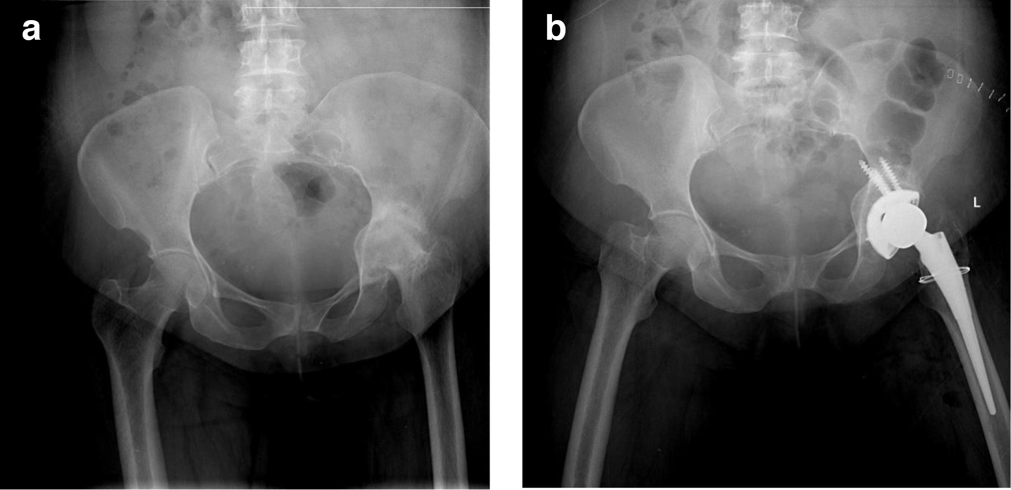 Fig. 2 
          a) Preoperative anterior-posterior radiograph showing unilateral osteoarthritis secondary to pyogenic infection. b) Postoperative radiograph showing total hip arthroplasty and intraoperative femoral fracture managed with wire cerclage.
        