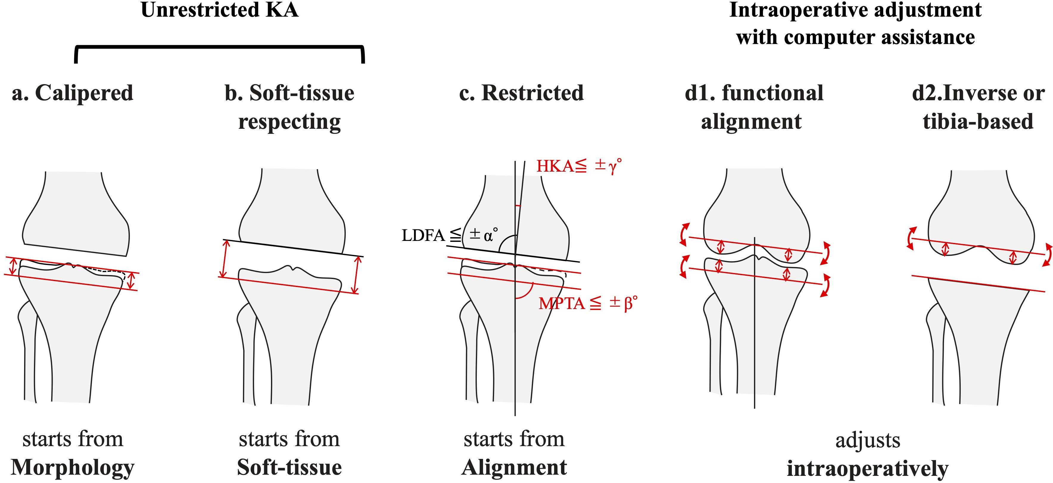Fig. 3 
            The variation of deciding the tibial cutting surface in the kinematic alignment total knee arthroplasties (KA-TKAs). a) Calipered (or pure, true) KA technique. The tibia is cut parallel to the tibial articular surface, compensating for the cartilage wear, similar to the femoral side. b) Soft-tissue respecting technique. The tibia is cut parallel to the femoral cutting surface under proper traction, parallel to the distal cutting surface of the femur in extension with respect to the trial component, and parallel to the posterior cutting surface of the femur in flexion. The calipered and soft-tissue respecting approaches are categorized as unrestricted KA. c) Restricted KA technique. A similar bone cut is done within the safe range (e.g. < 5° varus); otherwise, the resection is performed at a defined angle. Intraoperative adjustment with computer assistance: d1) Functional alignment. The tibial cutting surface along with the femoral cutting surface is decided based on the intraoperative information, including alignment and gap under computer assistance. d2). Inverse kinematic alignment or tibia-based KA. In this technique, the alignment of tibial component is decided first, followed by that of femoral component. Note that the femoral cutting line can be altered in these techniques. HKA, hip-knee-ankle angle; LDFA, lateral distal femoral angle; MPTA, medial proximal tibial angle.
          