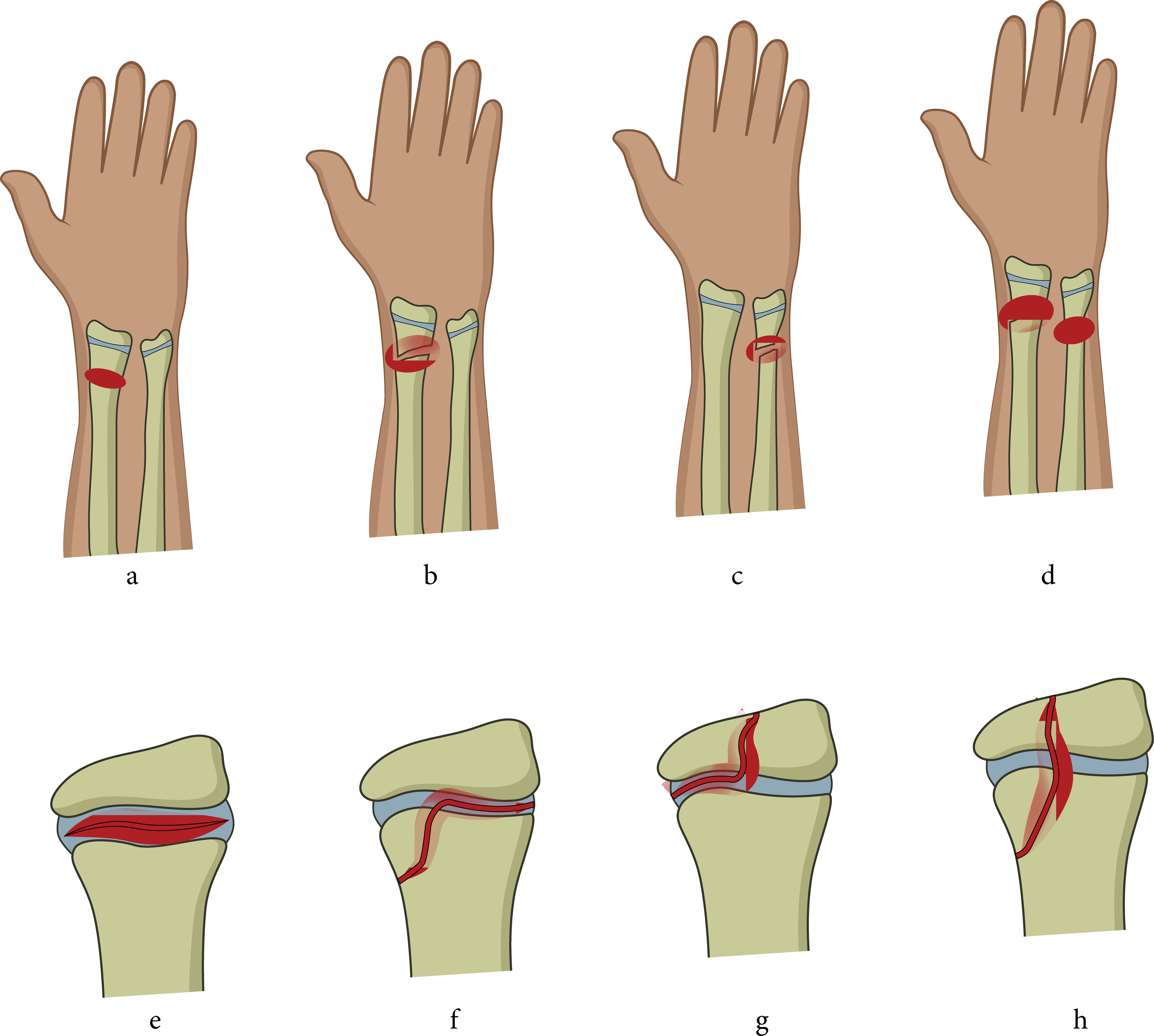 Fig. 1 
          Included children with a distal forearm fracture. legends: a) greenstick fracture (no distinguishing between greenstick and torus fractures); b) complete radius fracture; c) complete ulna fracture; d) complete radius and ulna fracture (antebrachium fracture); e) SH type 1; f) SH type 2; g) SH type 3; and h) SH type 4.
        