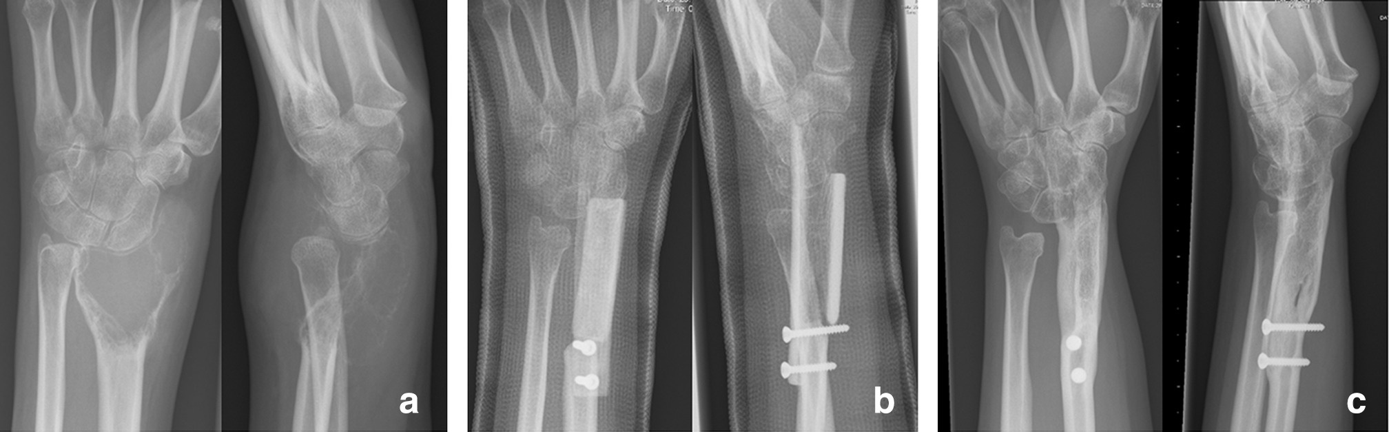 Fig. 2 
          a) 32-year-old patient with high-risk giant cell tumour of of the distal radius with cortical thinning, soft-tissue extension, and disturbed radiocarpal alignment. b) En bloc resection was performed with arthrodesis with a tibia strut autograft and screw fixation. c) Radiographs at five-year follow-up show complete fusion of both radiocarpal arthrodesis and proximal bone junction, with remodelling of the graft.
        