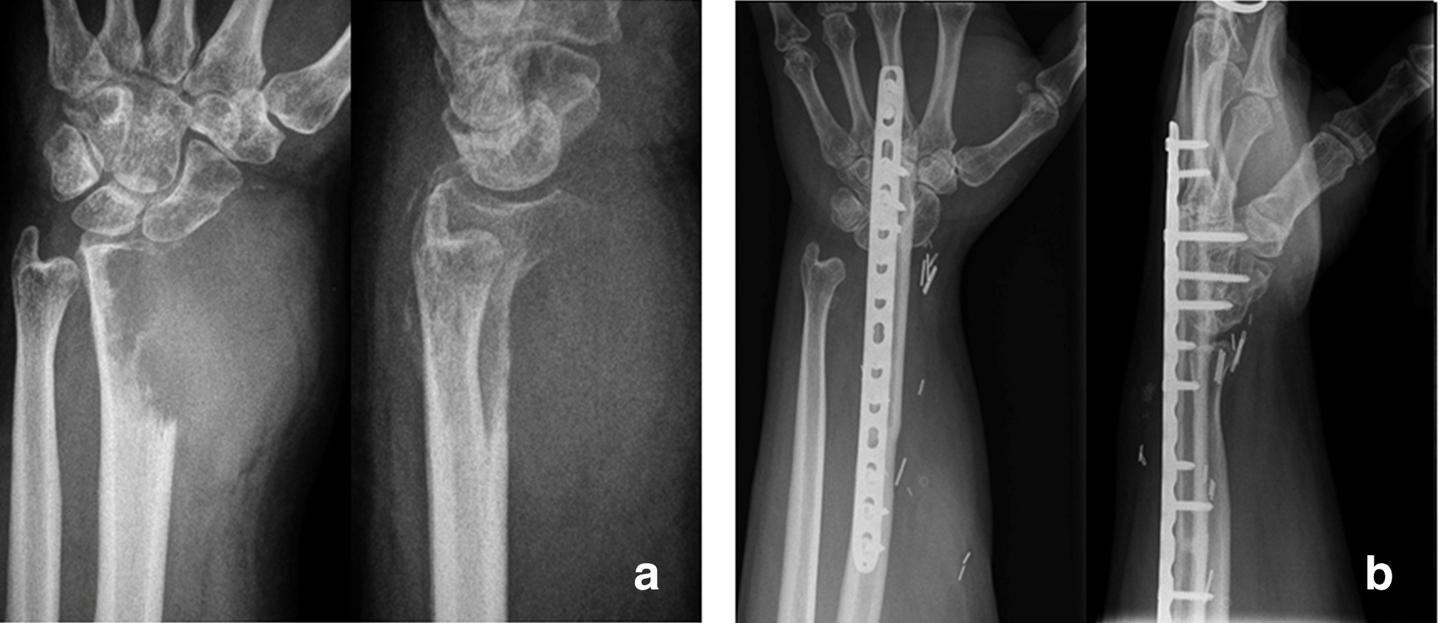 Fig. 3 
          a) 36-year-old patient with high-risk giant cell tumour of of the distal radius with cortical thinning and soft-tissue extension. b) En bloc resection was performed with wrist arthrodesis with osteoarticular allograft and plate fixation. There were no recurrences nor complications during 15-year follow-up.
        
