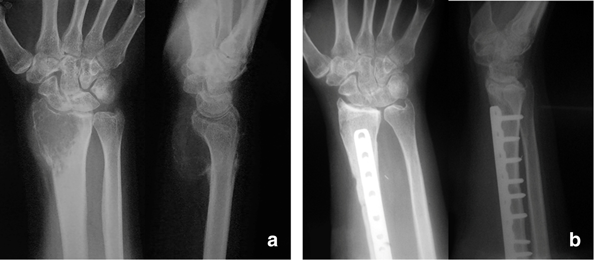 Fig. 4 
          a) 36-year-old patient with high-risk giant cell tumour of the distal radius with cortical thinning and very large soft-tissue component. b) En bloc resection was performed with wrist arthrodesis with a free vascularized fibula autograft and plate fixation. This patient developed pulmonary metastases, treated with continuous denosumab. Otherwise, there were no recurrences nor complications during ten-year follow-up.
        
