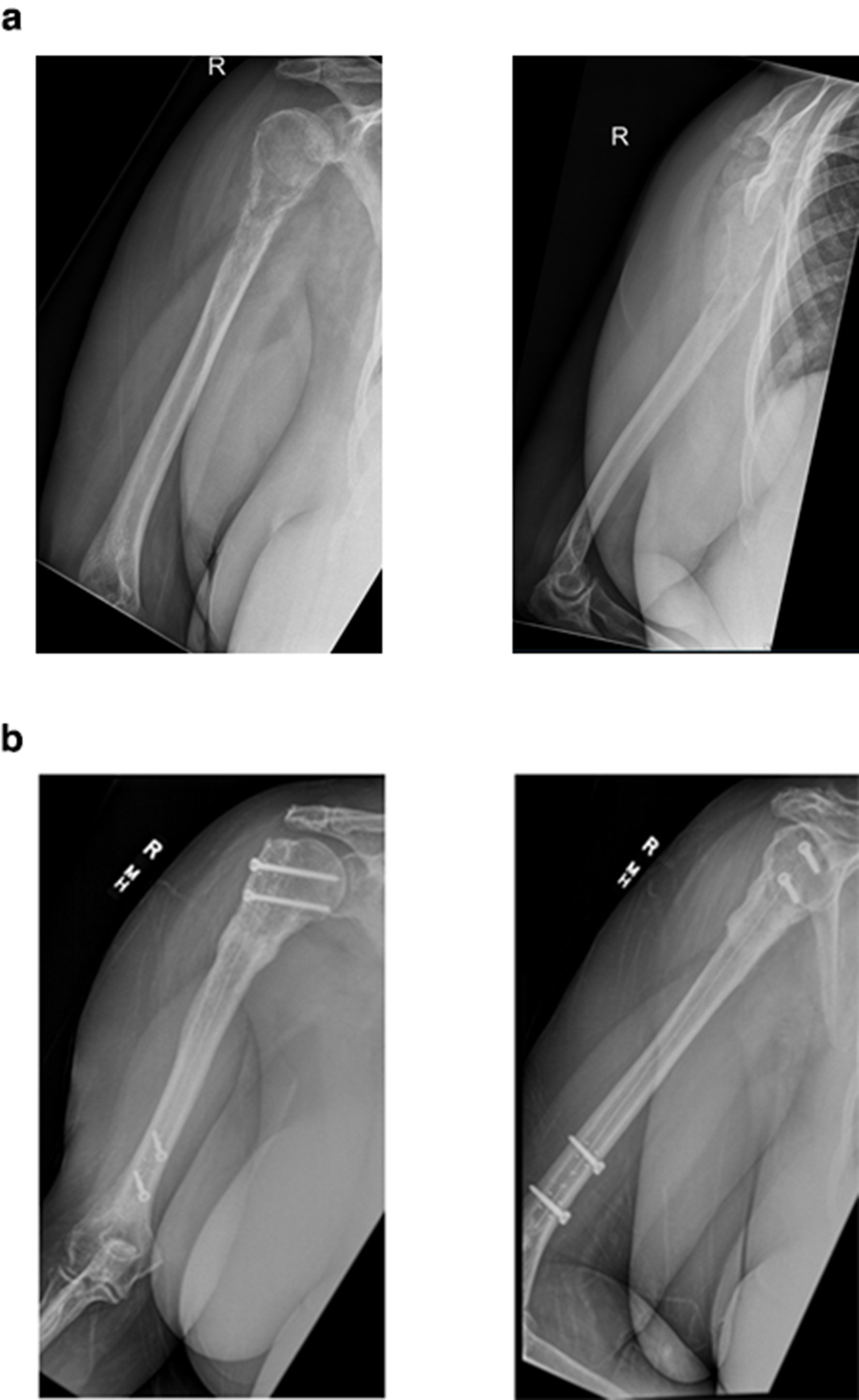 Fig. 2 
          a) Anteroposterior (AP) and lateral radiographs of the right humerus of a 66-year-old female with a pathological fracture lymphoma. b) AP and lateral radiographs of the healed right humerus at 11 months after intramedullary nail fixation with carbon fibre radiolucent implant, demonstrating its ability to allow for ongoing visualization of metastatic lesion location and healing of pathological fracture.
        