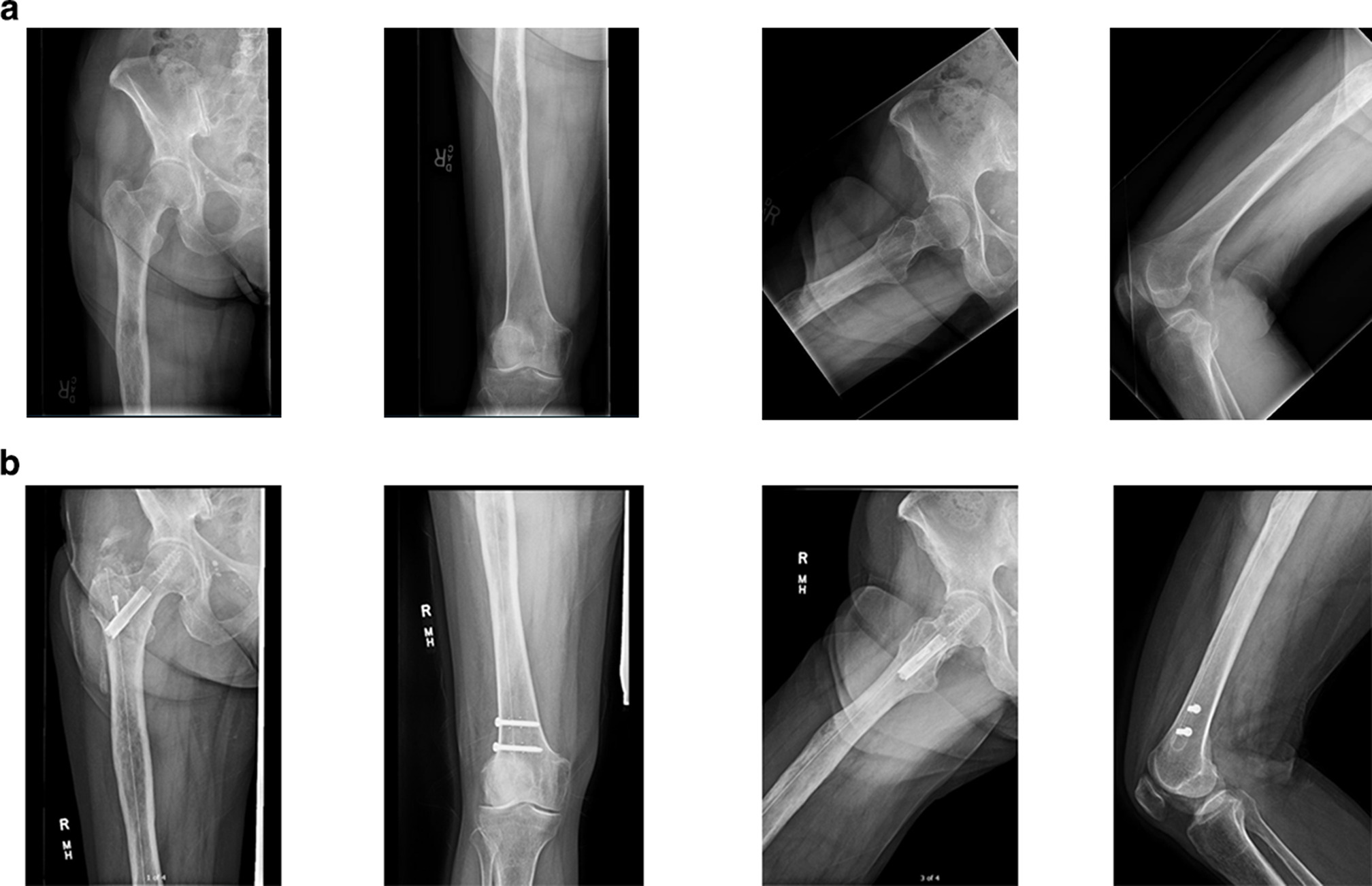 Fig. 3 
          a) Anteroposterior (AP) and lateral radiographs of the right femur of a 74-year-old female with a breast adenocarcinoma metastatic lesion noted in the proximal femur. b) AP and lateral radiographs of the right femur four months after placement of a prophylactic carbon fibre intramedullary nail. The proximal femoral lesion is visible given the radiolucency of the nail. This patient received post-surgical radiation.
        