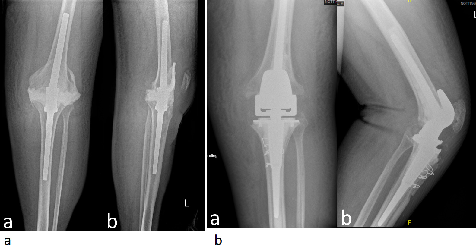 Fig. 2 
          a) Preoperative anteroposterior and lateral radiographs of left knee in a 79-year-old female with a fusion nail following first-stage revision for infection. b) Anteroposterior and lateral radiographs at three-year follow-up using Stanmore Modular Individualized Lower Limb System (SMILES) rotating hinge, with no loosening and satisfactory clinical outcomes.
        