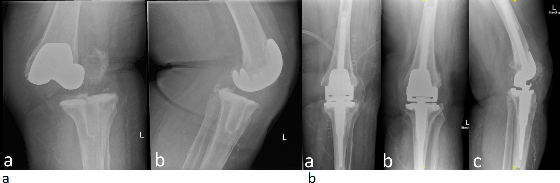 Fig. 3 
          a) Preoperative anteroposterior and lateral radiographs of a failed infected and dislocated total knee arthroplasty (TKA) in an 83-year-old female. b) Immediate postoperative, a) and two years follow-up; b-c) following revision TKA with a rotating hinge Stanmore Modular Individualized Lower Limb System (SMILES) prosthesis and satisfactory clinical and radiological outcomes.
        