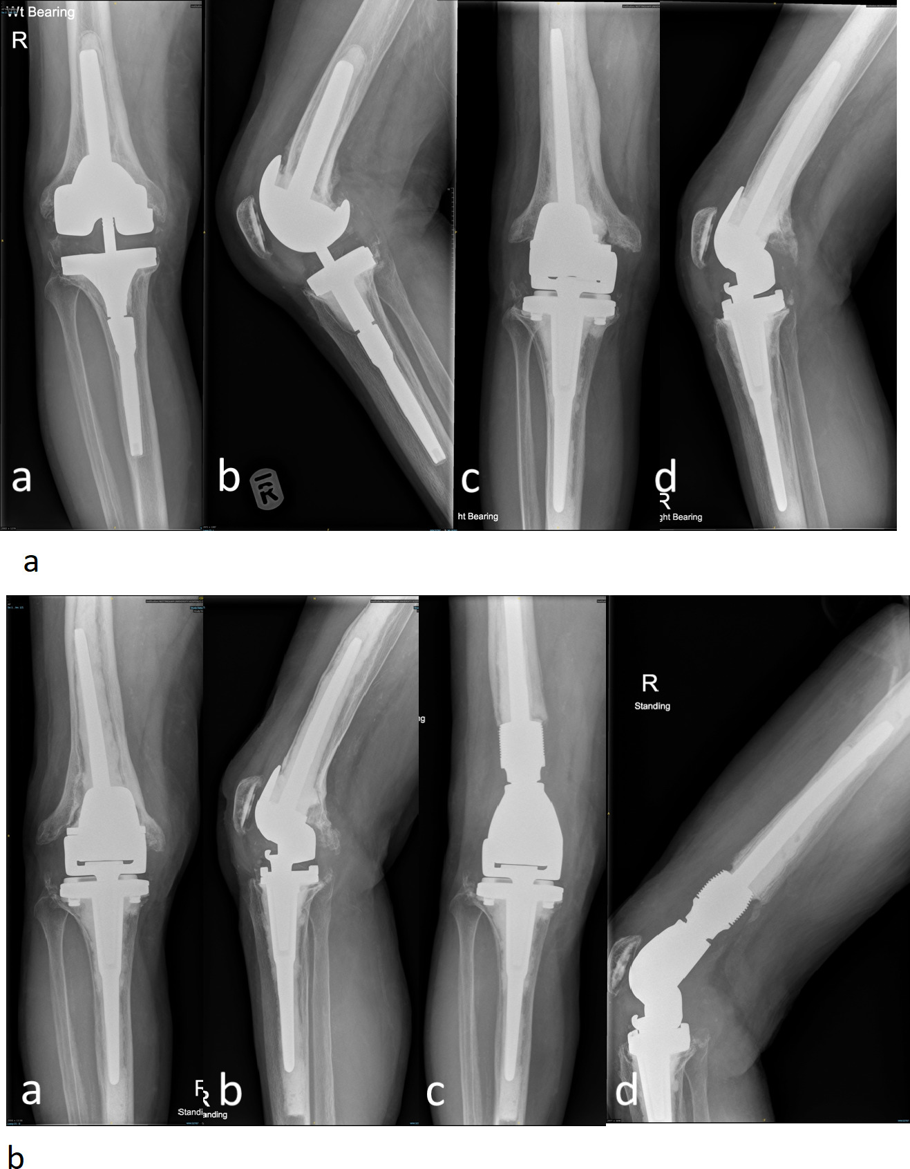 Fig. 4 
          a, b) Preoperative anteroposterior and lateral radiographs of right revision knee in a 75-year-old female with aseptic loosening and instability. c, d) Postoperative radiographs following re-revision total knee arthoplasty with a rotating hinge Stanmore Modular Individualized Lower Limb System (SMILES) prosthesis. b) Anteroposterior and lateral radiographs at 5.6 years follow-up with loosening around the femoral component with well-fixed tibial component. c, d) Anteroposterior and lateral radiographs following single component revision to a distal femoral replacement of the same system retaining the tibial component.
        
