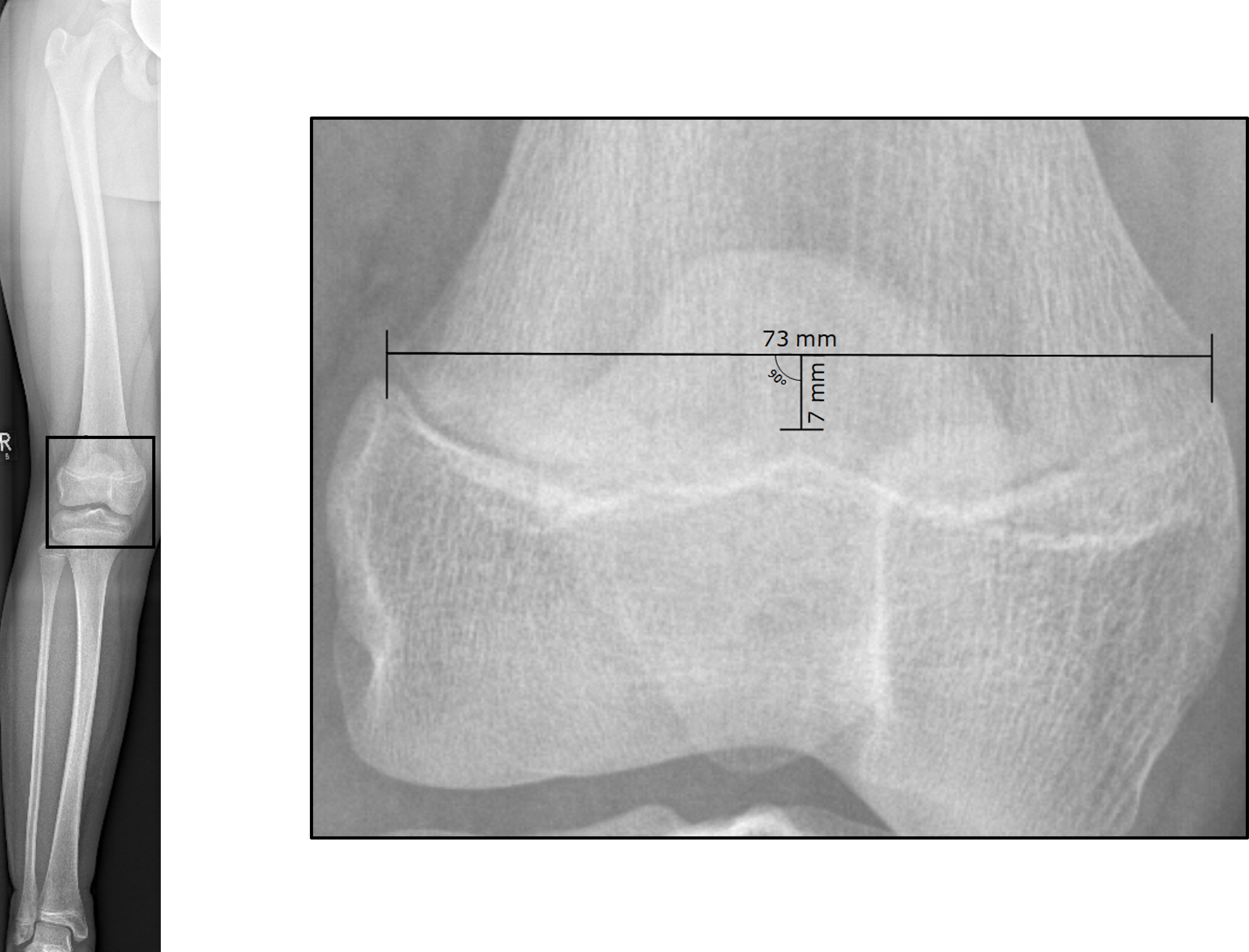 Fig. 1 
            Determination of skeletal age using the central peak height method on a long leg radiograph (age 11 years 9 months, female). First, a scalable, standardized, digital long leg radiograph was taken in an anteroposterior orientation no more than one month before surgery and used to evaluate the central peak value (CPV). The CPV was calculated by dividing the distance between the central peak of the distal femoral physis and a line between the medial and lateral ends of the distal femoral physis (7 mm) by the width of the distal femoral physis (73 mm). The CPV value was then used to determine skeletal age.
          