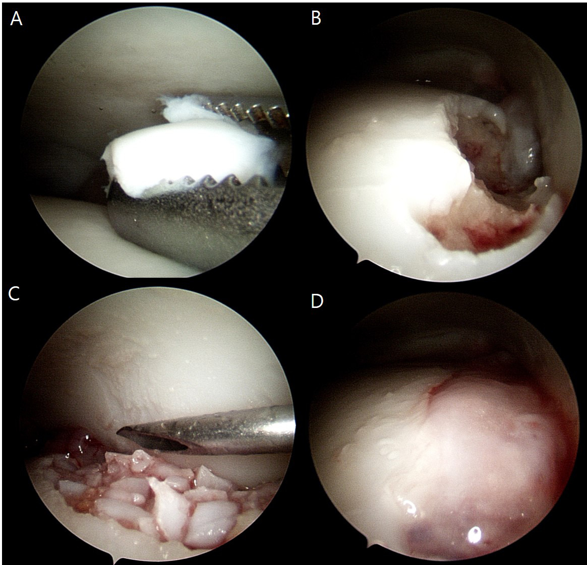 Fig. 1 
            a) Detached cartilage of the osteochondral lesion was harvested using a grasper. b) Subchondral bone defect was curetted and microfracture was performed to create a sufficient bleeding surface. c) After saline drainage, under direct visualization using a dry-scope, the particulated cartilages were transplanted to fill the lesion. d) Fibrin glue was applied over the cartilage fragments for stabilization.
          