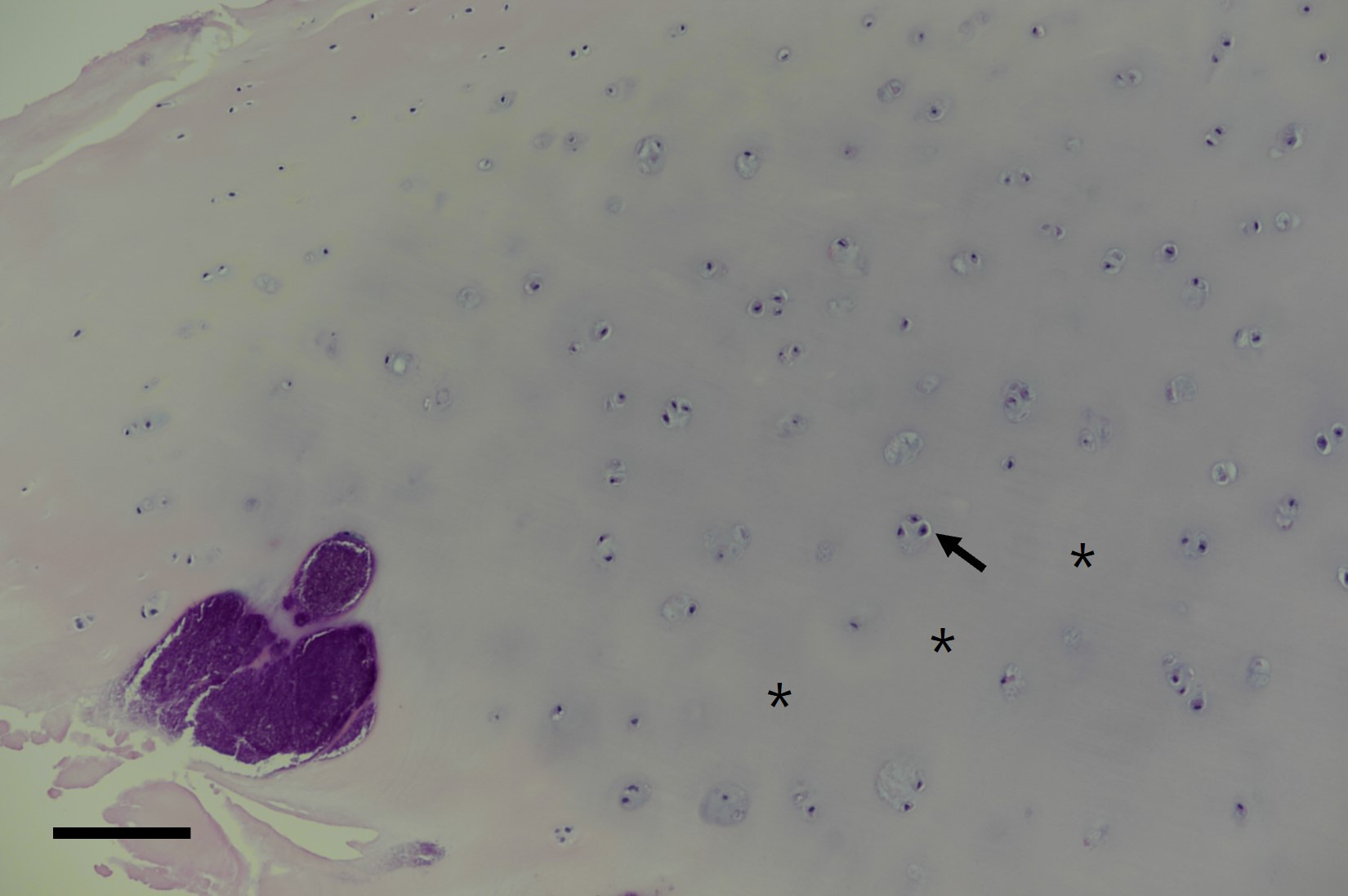 Fig. 2 
          Representative of the histological examination of a detached lesion cartilage. Hematoxylin and eosin staining was performed to check cell viability. Live chondrocytes within the lacunae (arrow) and the hyaline matrix (asterisk) were confirmed in all specimens (n = 32) (scale bars 200 μm).
        