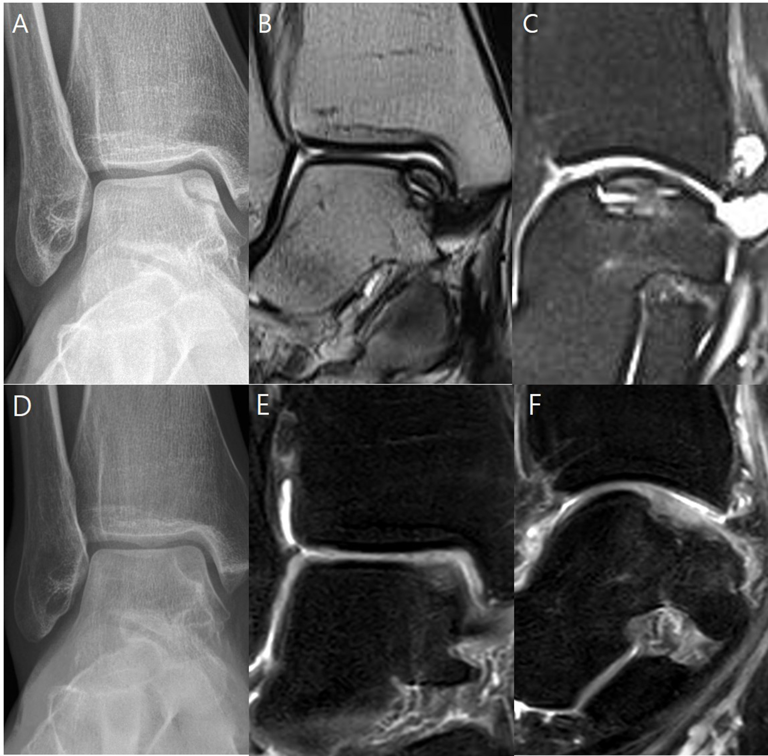 Fig. 3 
          a, b, and c) Preoperative standing anteroposterior radiograph and MRI scans of a 20-year-old female patient showing a completely detached osteochondral lesion (10 mm width, 20 mm length) on the medial talar dome. d, e, and f) 11-month postoperative images showing restoration of the lesion with homogenous cartilage well integrated with the surrounding cartilage. Note the reduced joint fluid in the postoperative MRI (f) compared to the preoperative image (c).
        