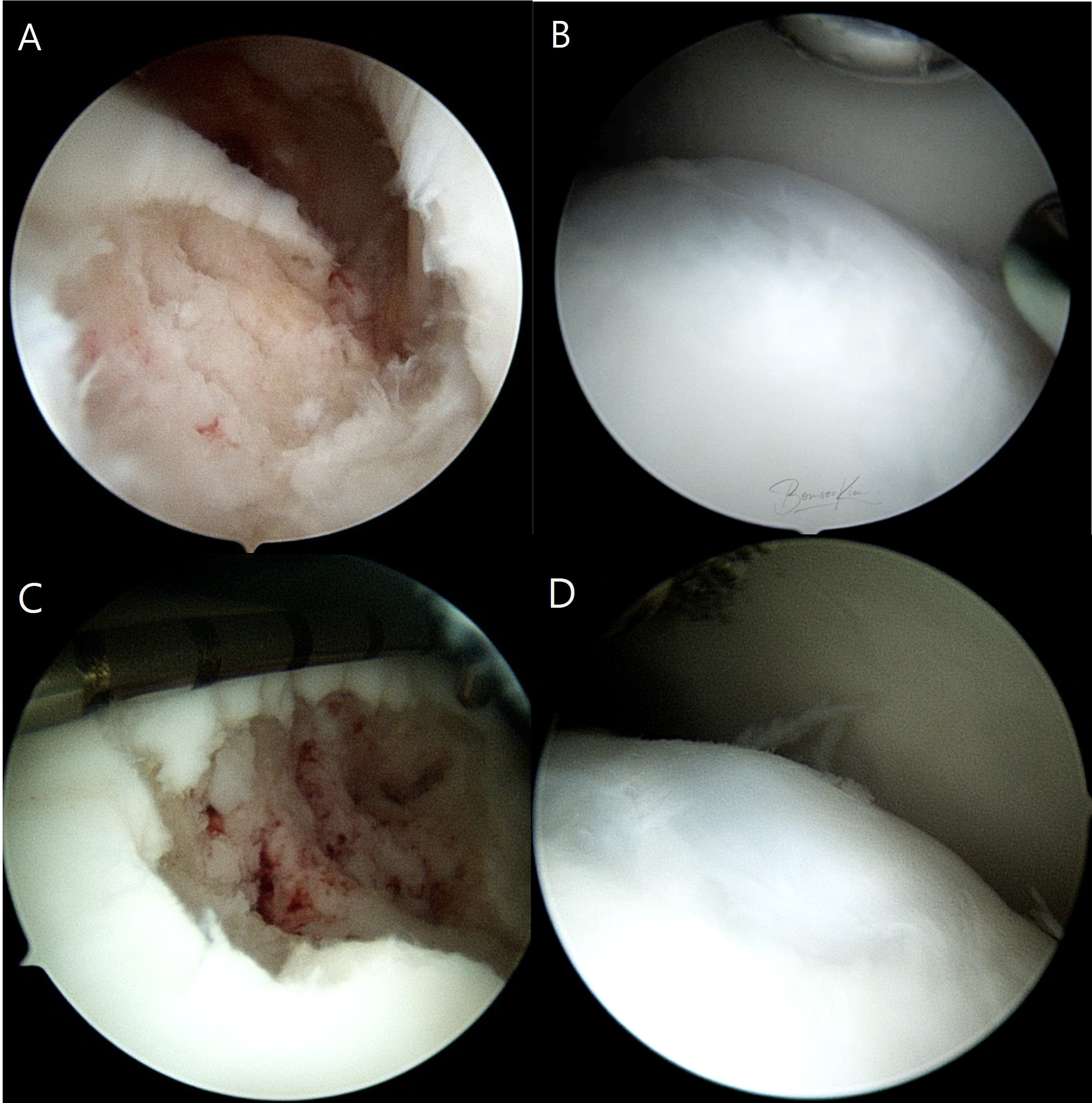 Fig. 4 
          a, c) Initial arthroscopic findings of two patients after microfracture and their corresponding second-look arthroscopic findings (b,d). a, b) A 21-year-old male patient with preoperative and 11-month postoperativearthroscopic findings with grade I International Cartilage Repair Society (ICRS) score. c, d) A 25-year-old female patient with preoperative and 12-month postoperative arthroscopic findings with grade I ICRS score.
        