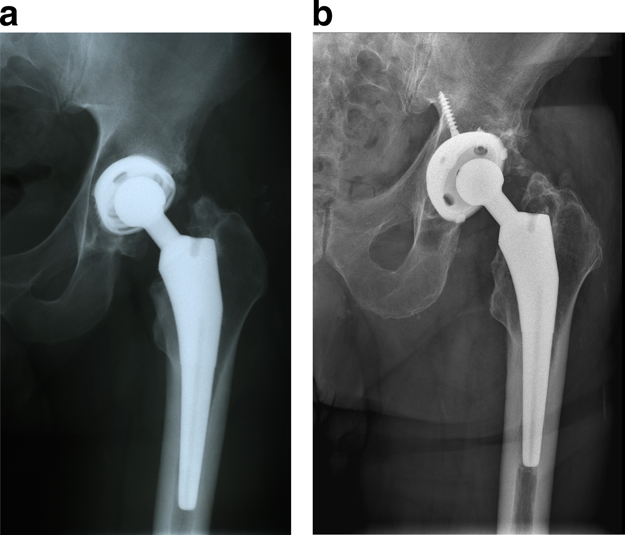 Fig. 2 
            Anteroposterior radiographs of the left hip taken at a) one month after primary total hip arthroplasty, and b) at 37 years.
          