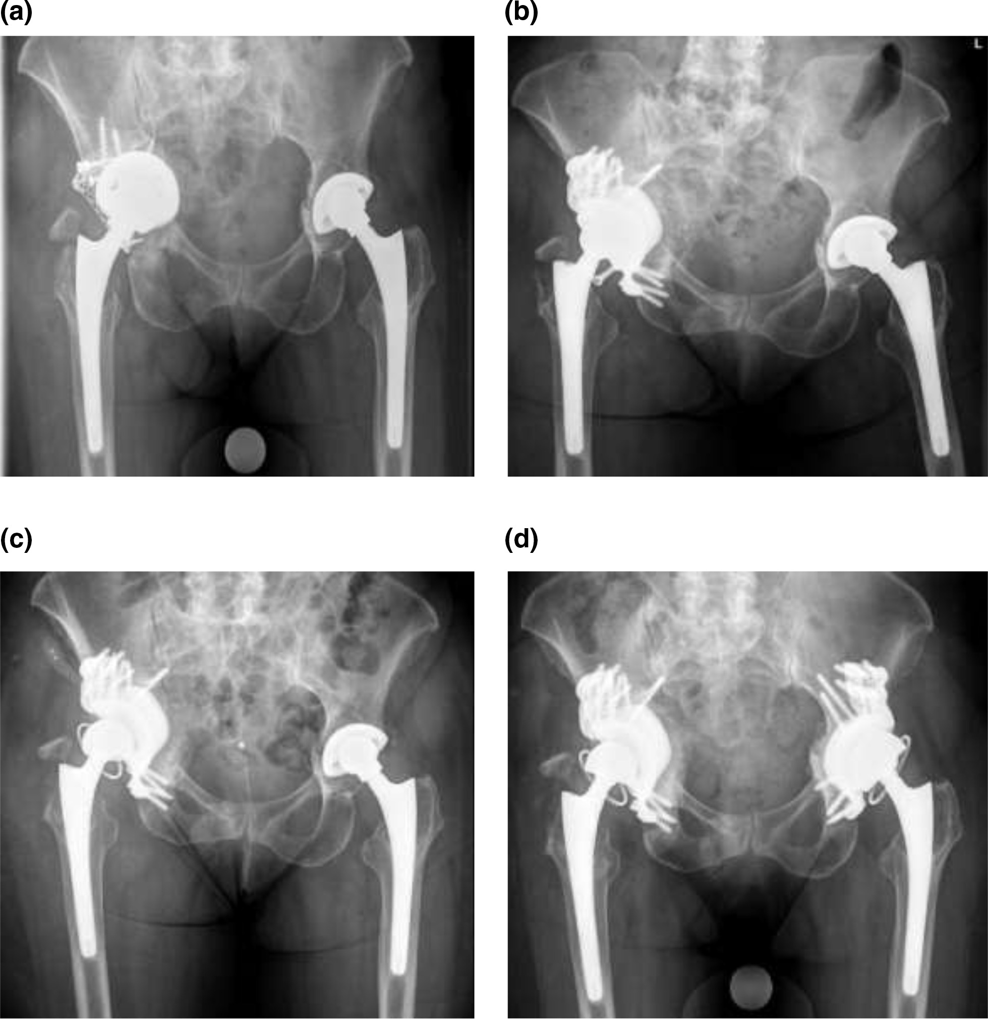 Fig. 1 
            Case example (case B) of a patient with concurrent (i.e. synchronous) bilateral pelvic discontinuity. A complete discontinuity is shown between the superior and inferior pelvis. b) Non-immediate postoperative anteroposterior pelvic radiograph with a custom-made triflange component of the right hip. Note the concurrent pelvic discontinuity on the left side. c) Revision of the custom-made triflange component on the right hip due to recurrent dislocations six weeks postoperatively, which was managed by open reduction and conversion from a dual-mobility cup to a constrained liner. d) After 11 months: revision of the left hip to a custom-made triflange component with a constrained liner.
          