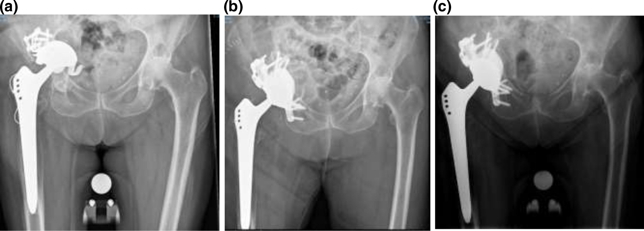 Fig. 2 
            a) Preoperative anteroposterior pelvic radiograph: failed acetabular component with protrusion and pelvic discontinuity. b) An immediate postoperative radiograph demonstrating a fixed custom-made triflange component. c) A two-year postoperative radiograph demonstrating fixation and healed discontinuity.
          
