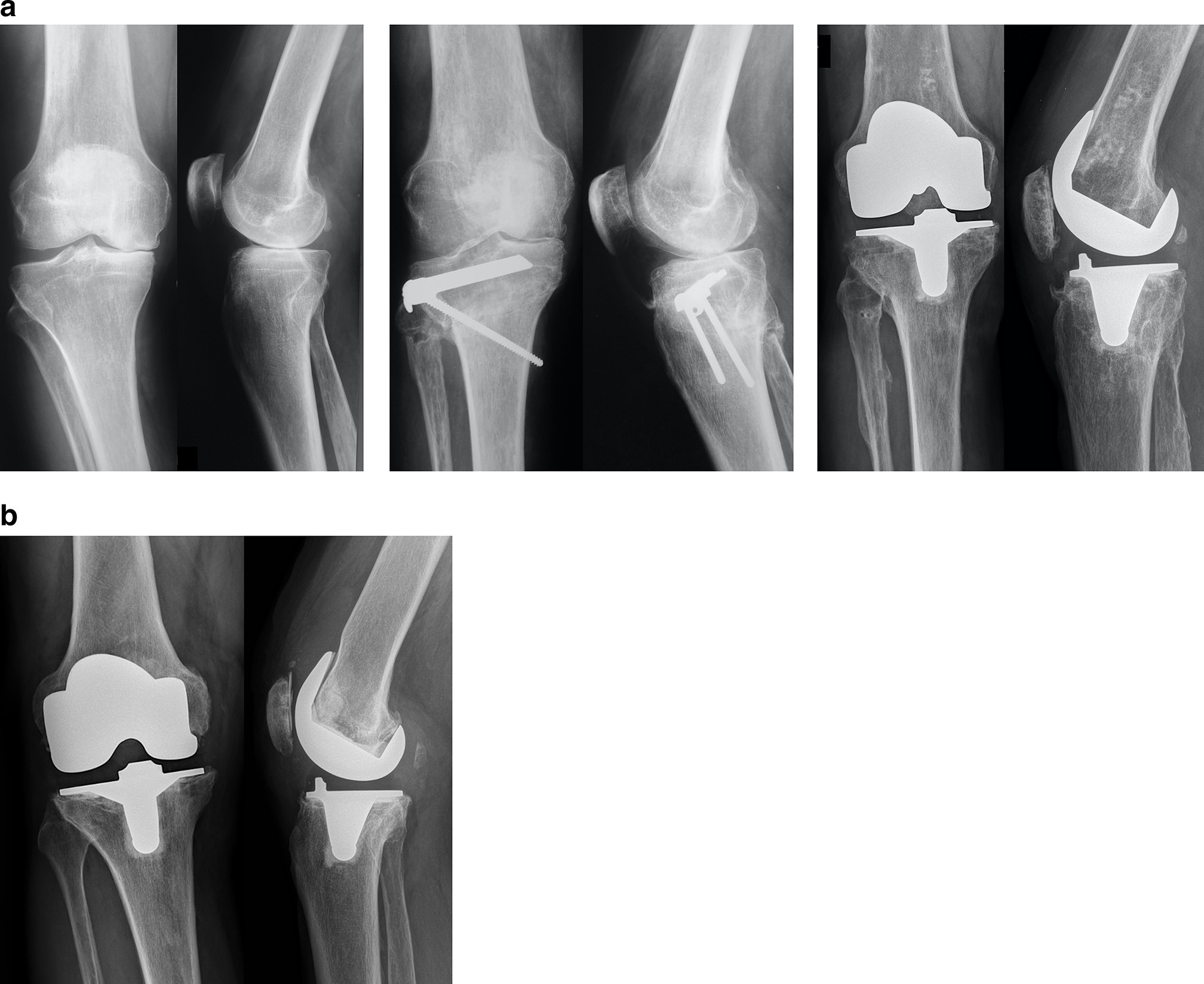 Fig. 3 
            a) Radiographs of a left knee (male, 52 years old) showing monocompartmental osteoarthritis (OA) before high tibial osteotomy (HTO), at eight years after HTO followed by total knee arthroplasty (TKA) at 18 years of follow-up, with good clinical outcomes. b) Radiographs of a right knee showing TKA with symptomatic tibial and femoral aseptic loosening at 12 years of follow-up in a young patient (male, 56 years old at the time of TKA implantation).
          