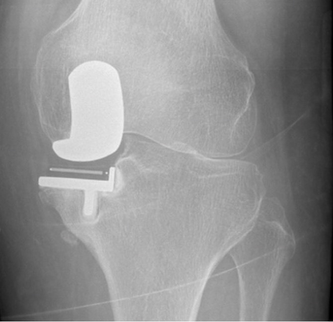 Fig. 2 
            Example of anteroposterior radiograph of an 87-year-old female patient with poor alignment causing a falsely small lateral joint space width.
          