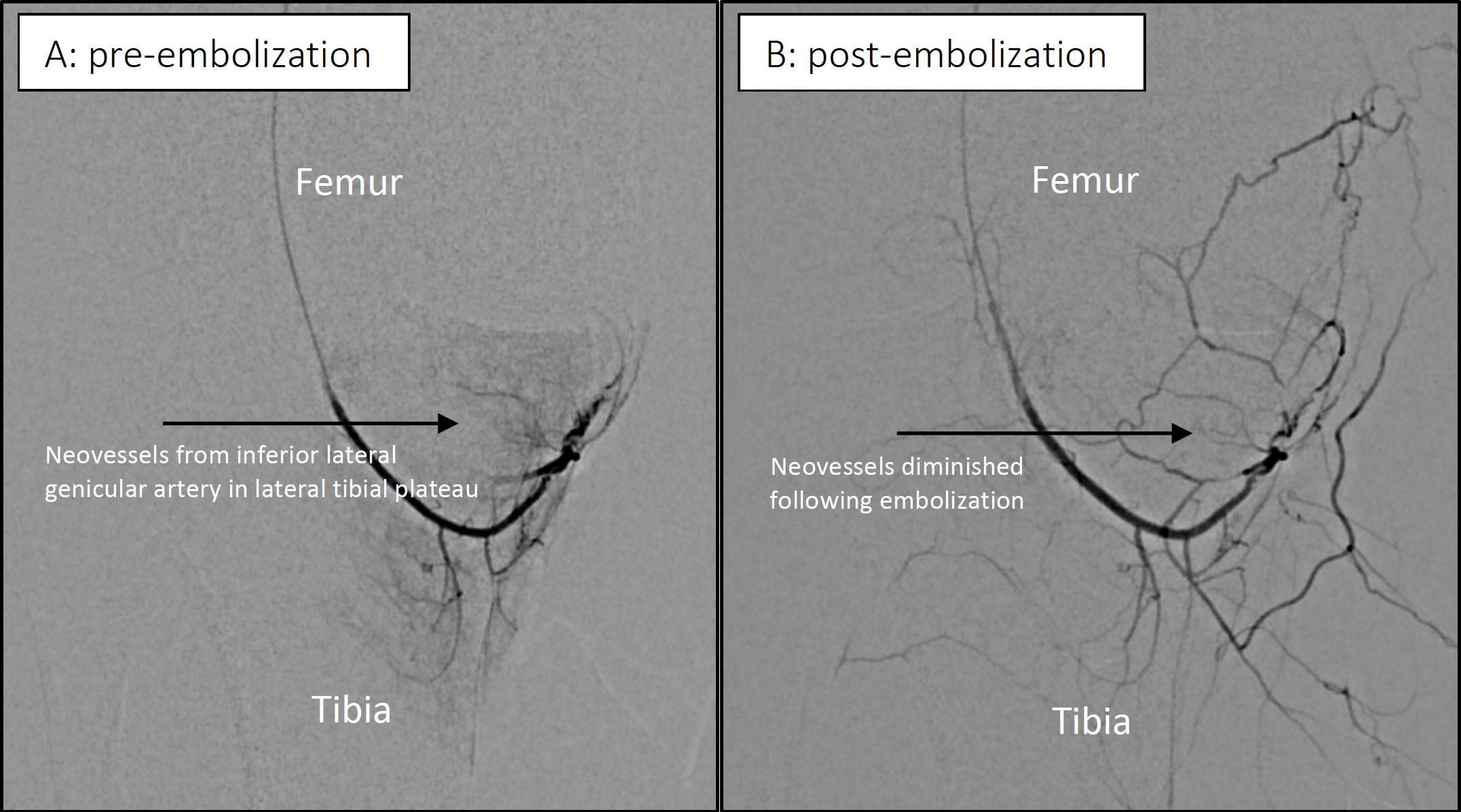 Fig. 1 
            Angiological findings a) before and b) after transcatheter arterial embolization. Pre-embolization findings demonstrate extensive neovasculature in the lateral tibial condyle that is absent postembolization.
          