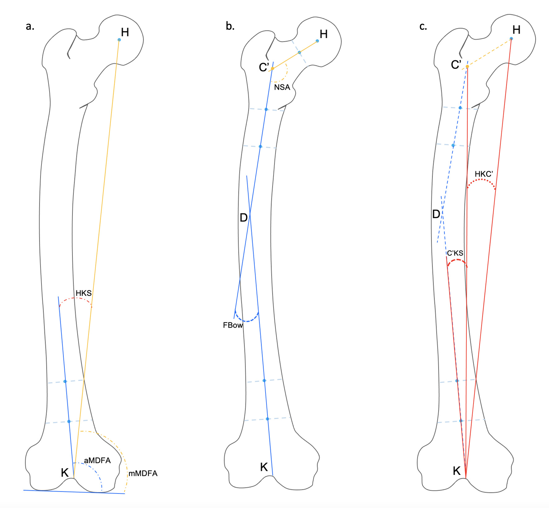 Fig. 2 
            Femoral radiological measurements performed on the preoperative full long-leg radiograph for each patient. aMDFA, anatomical medial distal femoral angle; C'KS angle (angle between the distal femoral shaft axis and the line joining C’ and the knee centre K); FBow, femoral bowing angle; HKC’ angle (angle between the mechanical axis line of the femur and the line joining C’ and the knee centre K); HKS, hip knee shaft angle; mMDFA, mechanical medial distal femoral angle; NSA, femoral neck shaft angle.
          