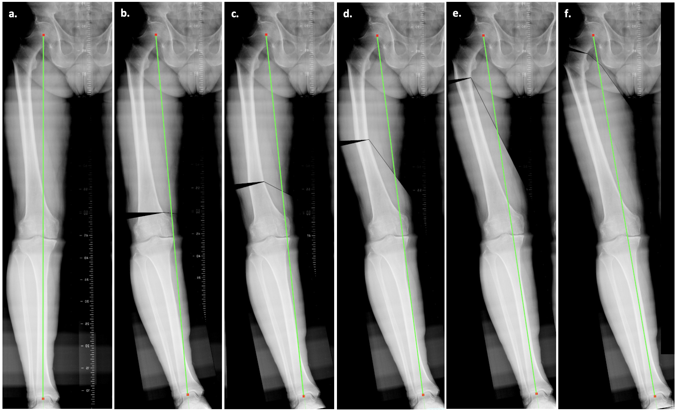 Fig. 5 
            Radiological models of the modifications of the weightbearing line (Mikulicz line) according to the level of the femoral deformity. a) No deformity; b) 10° of distal metaphyseal deformity; c) 10° of distal diaphyseal deformity; d) 10° of middle third diaphyseal deformity; e) 10° of proximal diaphyseal deformity; and f) 10° of proximal deformity.
          