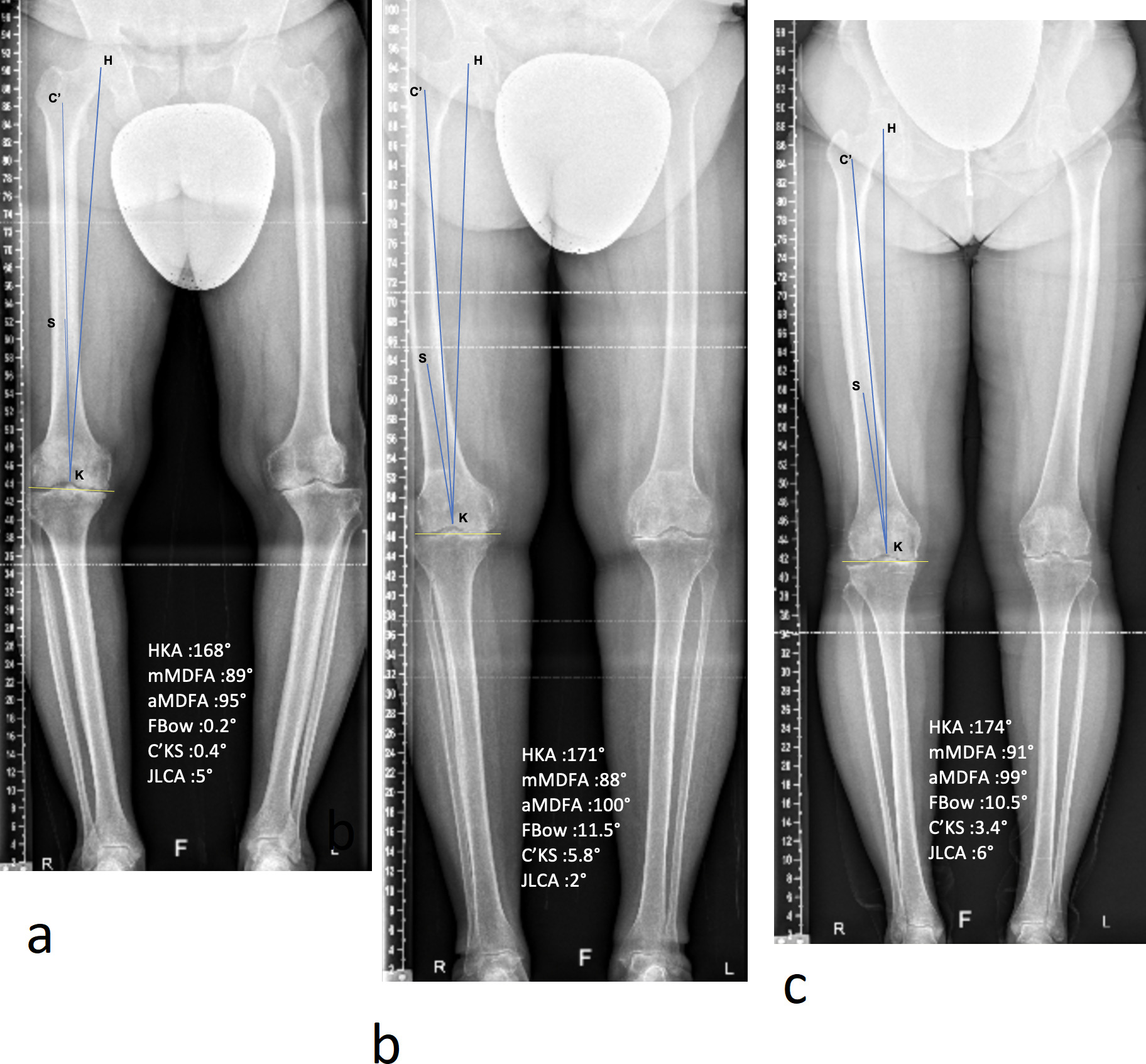 Fig. 6 
            Three full long-leg radiograph showing examples of femoral deformity. a) Right knee with a distal metaphyseal varus deformity and without diaphyseal deformity. b) Right knee with a diaphyseal varus deformity (middle of the shaft) and a high FBow impact on the knee alignment (5.8°). c) Right knee with a diaphyseal varus deformity (proximal part of the shaft). While the FBow angle was similar to the Figure 5b, the FBow impact on the knee was low because the deformity was far away from the knee. aMDFA, anatomical medial distal femoral angle; FBow, femoral bowing angle; HKA, hip-knee-ankle angle; JLCA, joint line convergence angle; mMDFA, mechanical medial distal femoral angle; MPTA, medial proximal tibial angle.
          